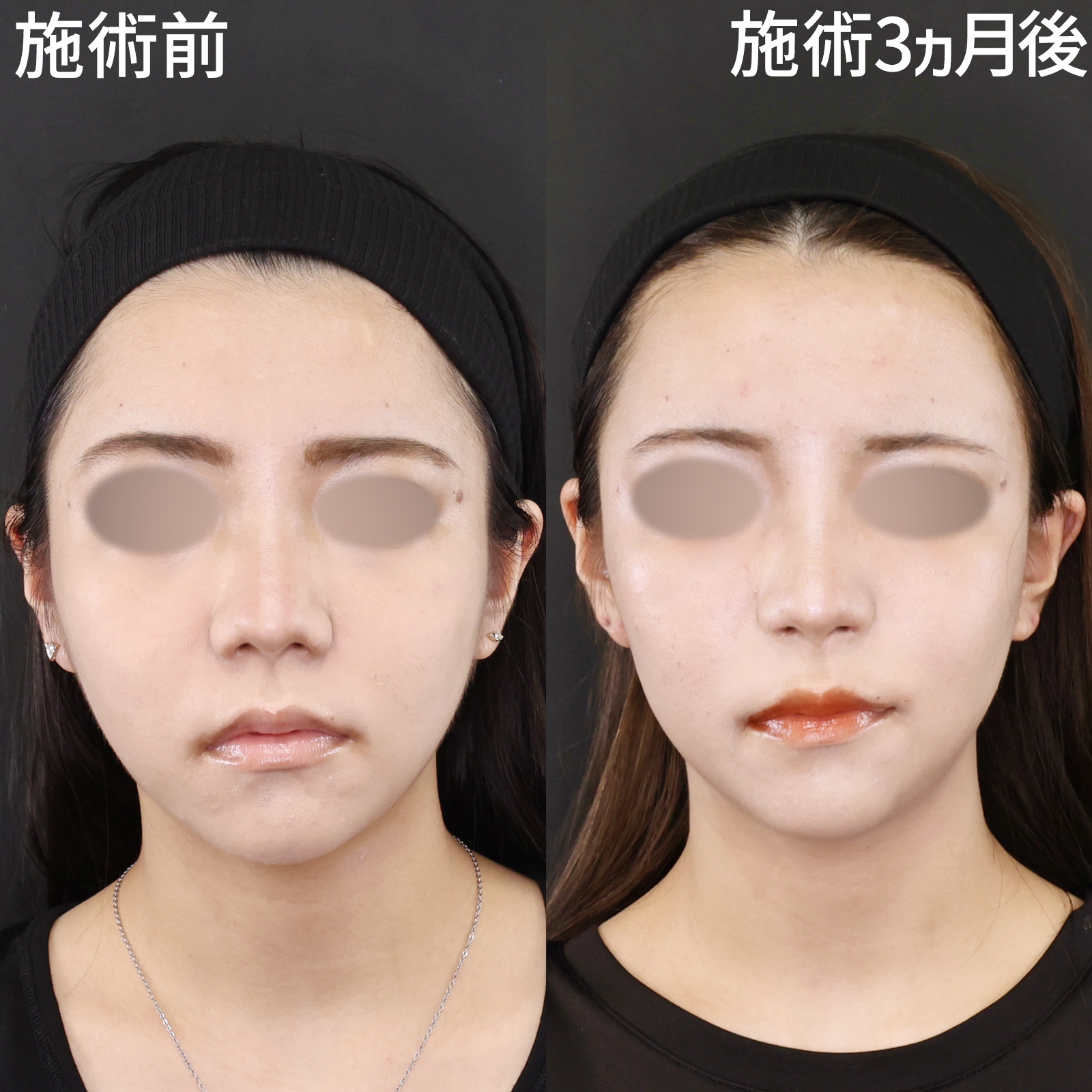 【小鼻縮小＆鼻翼挙上】重たい印象をスッキリと！ACRも整い、美しい忘れ鼻に。