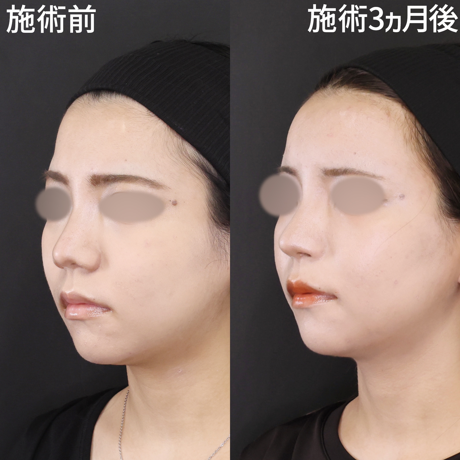 鼻翼挙上術/鼻孔縁挙上術/TAC式 鼻翼縮小術（小鼻縮小）の症例写真 施術前後 