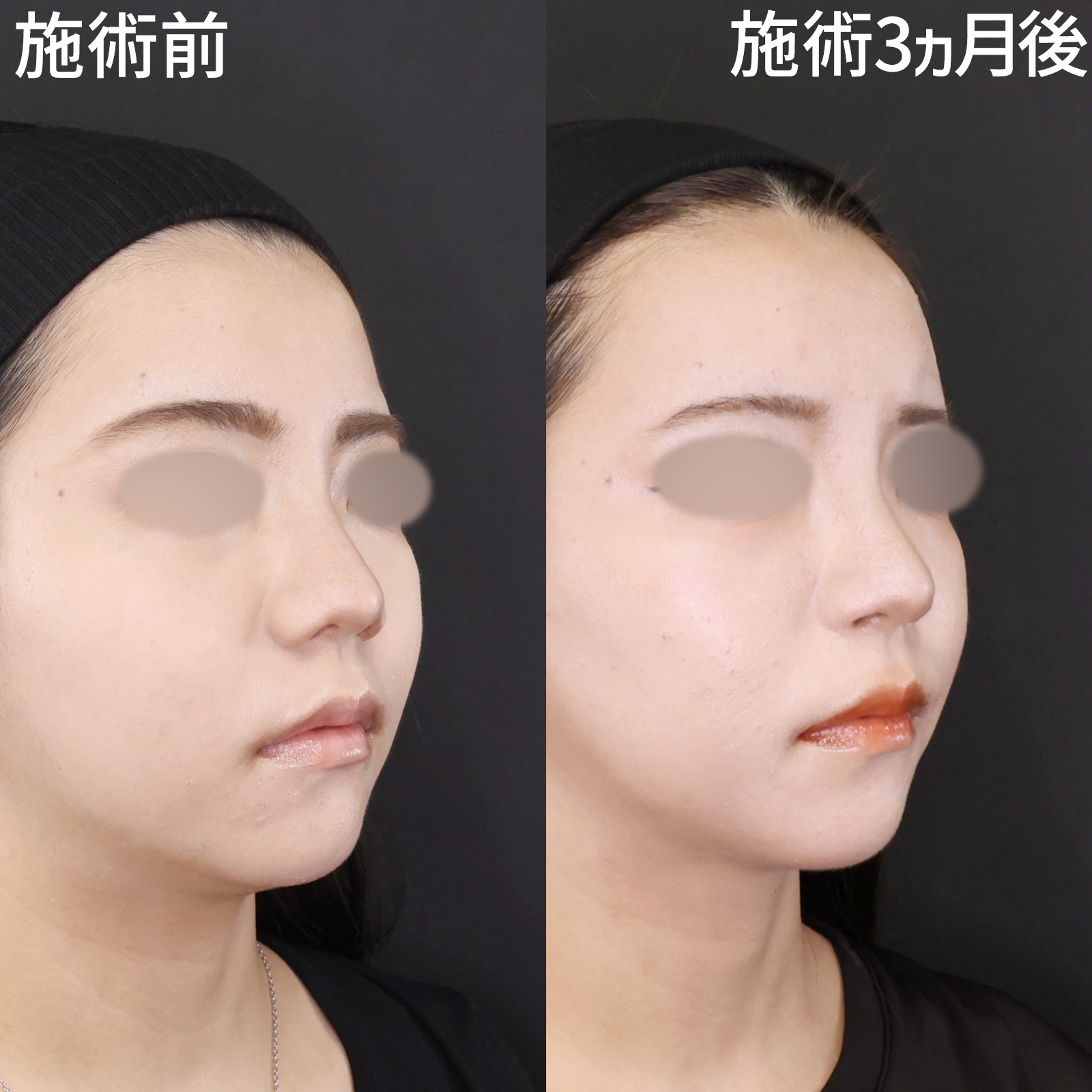 鼻翼挙上術/鼻孔縁挙上術/TAC式 鼻翼縮小術（小鼻縮小）の症例写真 施術前後 