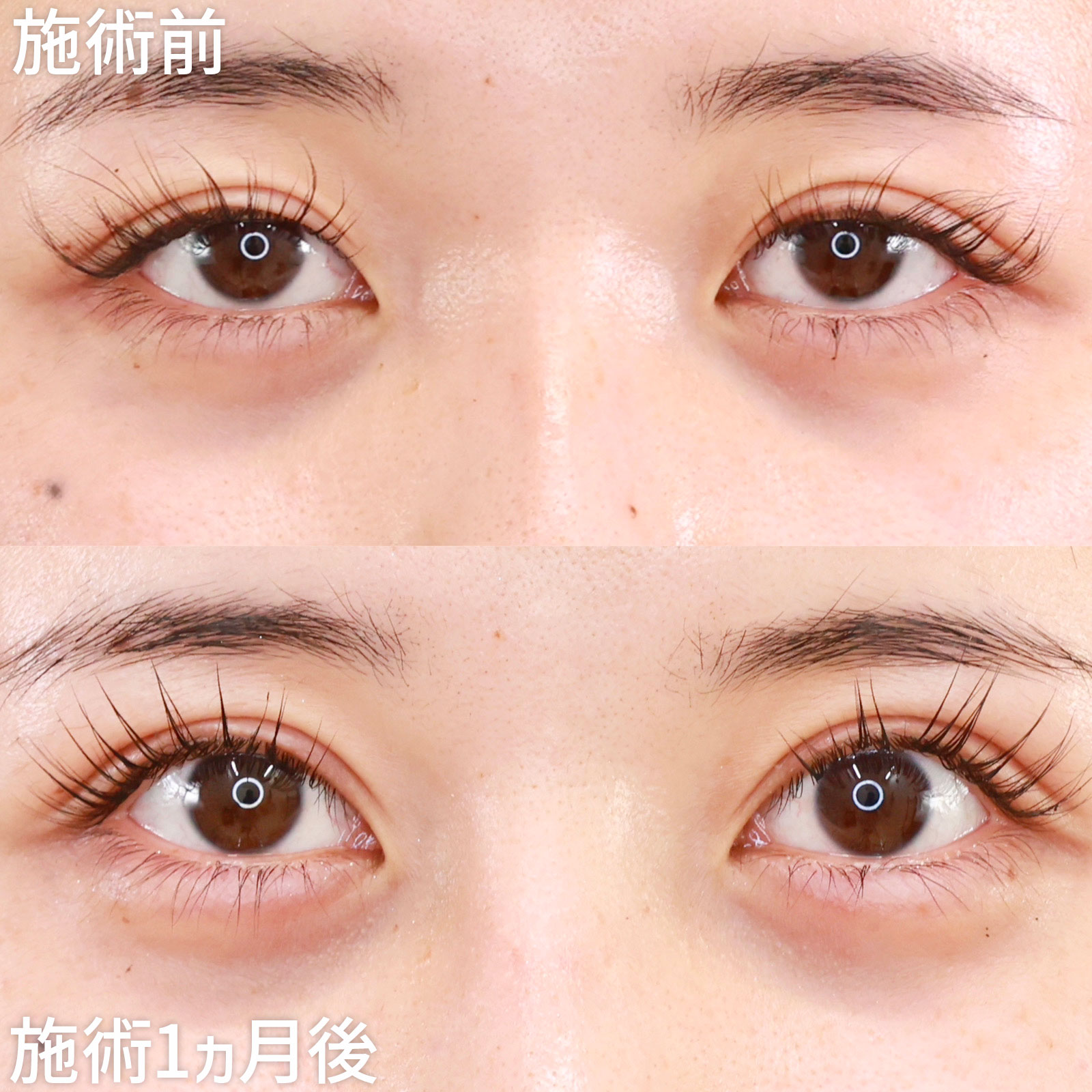 【修正手術】上眼瞼切開術と眼瞼下垂でパッチリとした目元に！