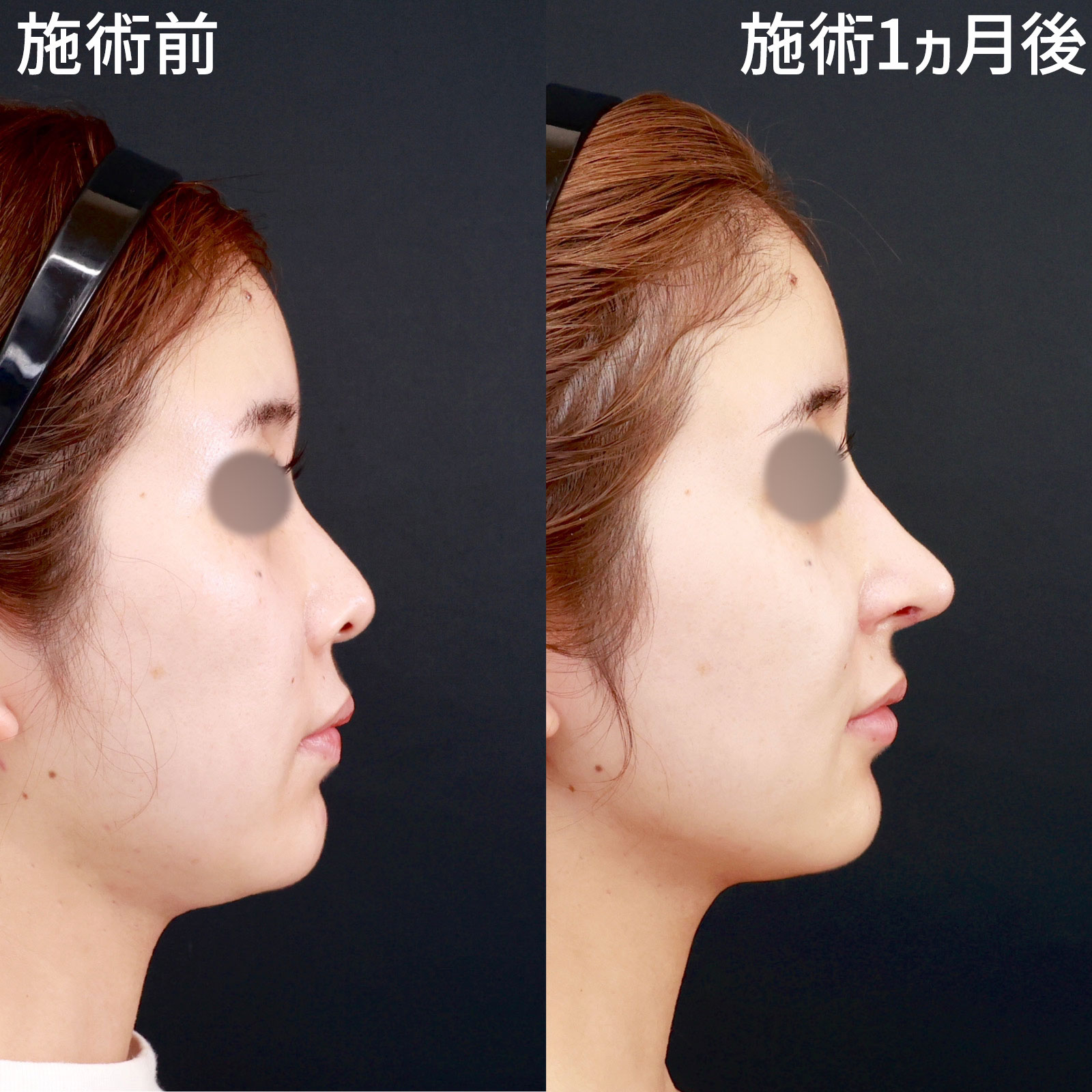 鼻中隔延長術/鼻先軟骨移植/鼻孔縁挙上術の症例写真 施術前後 