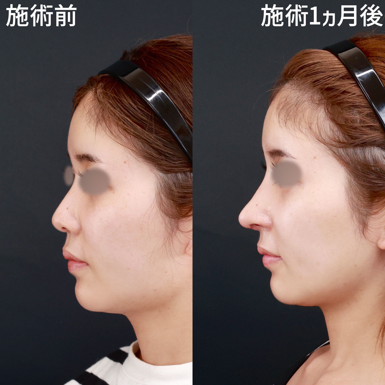 鼻中隔延長術/鼻先軟骨移植/鼻孔縁挙上術の症例写真 施術前後 