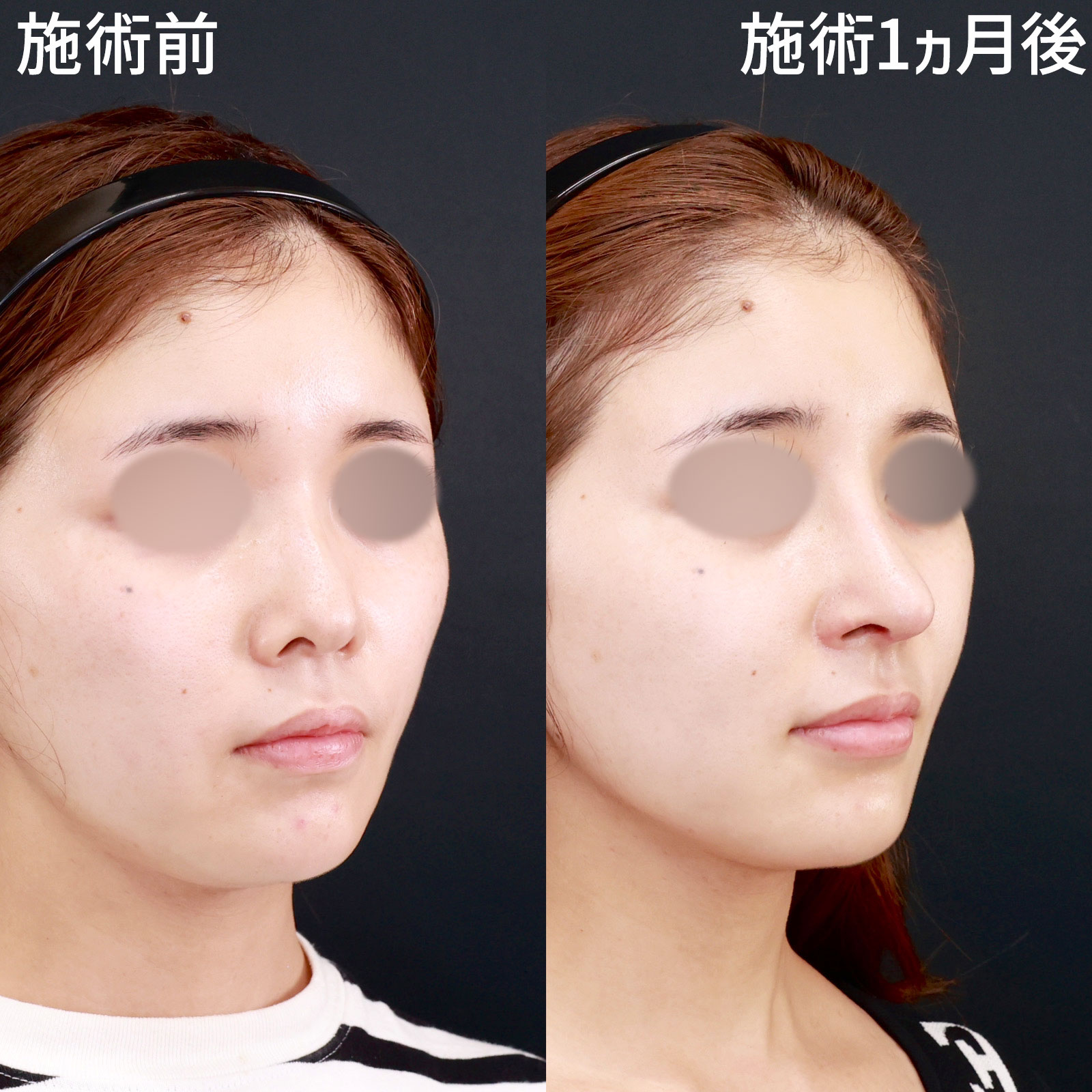 鼻中隔延長術/鼻先軟骨移植/鼻孔縁挙上術の症例写真 施術前後 