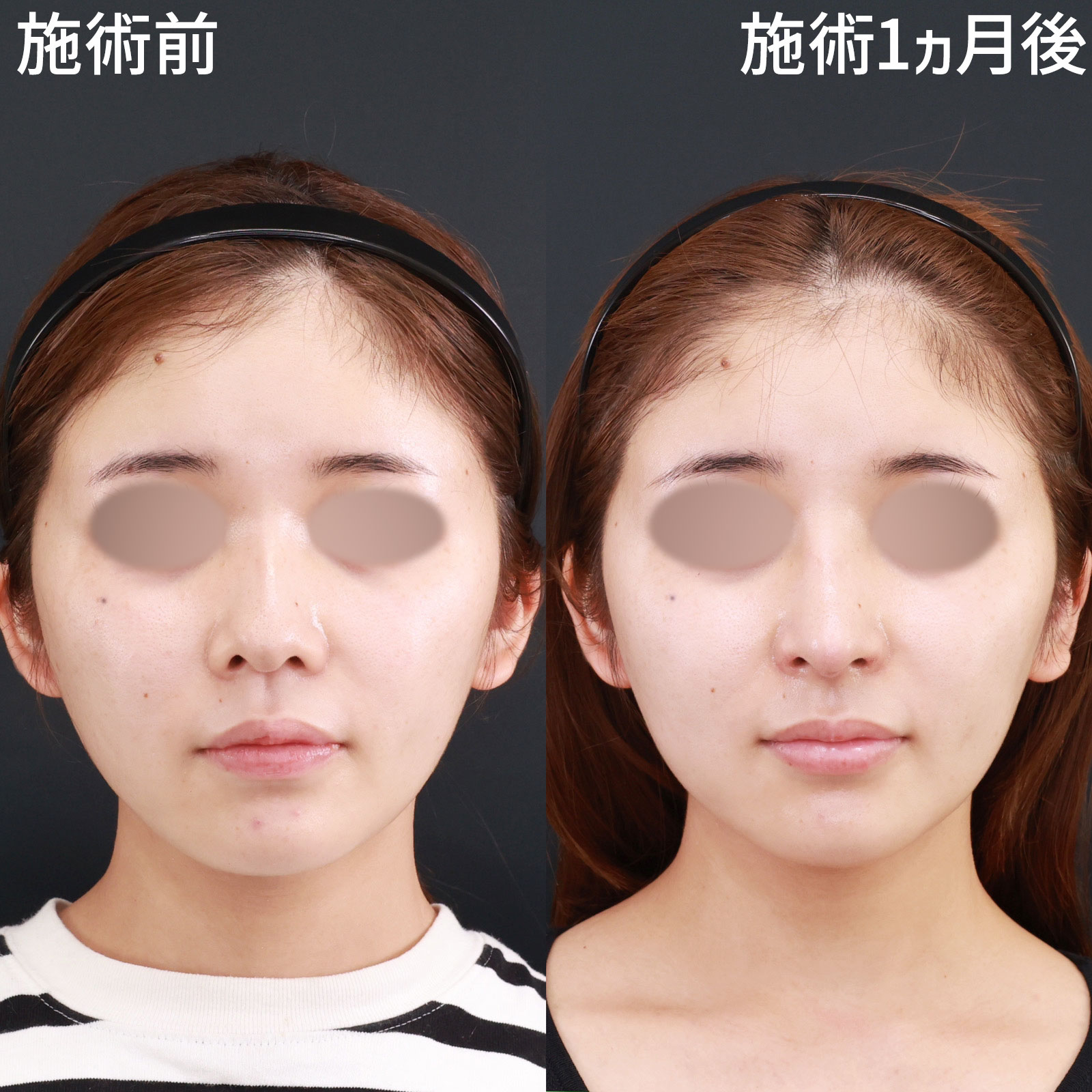 鼻中隔延長術/鼻先軟骨移植/鼻孔縁挙上術の症例写真 施術前後 