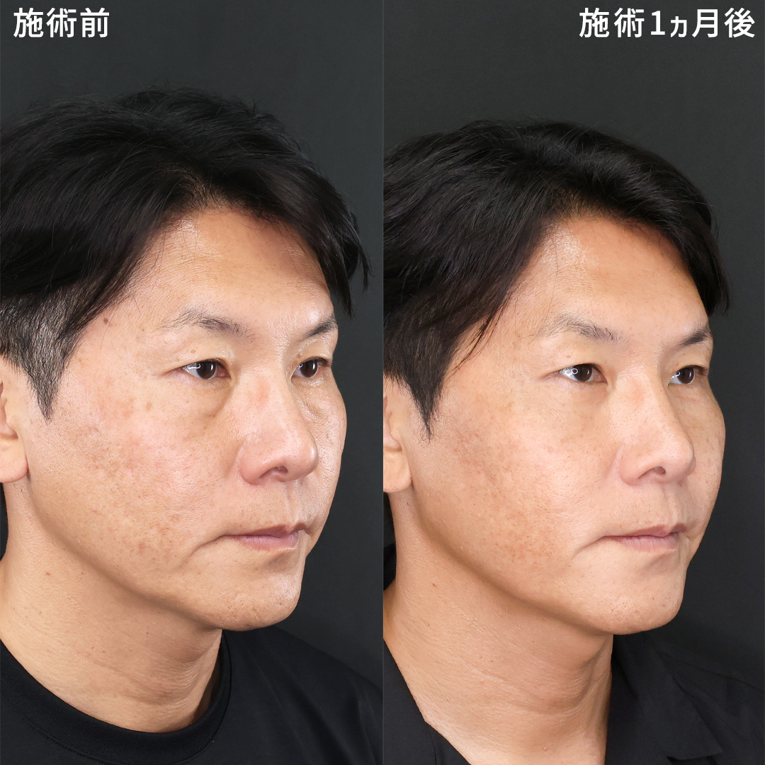 《クマ取り》男性も-10才で若々しい印象に