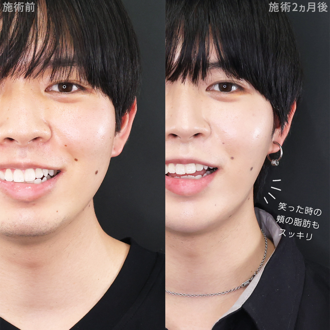 TAC式 ツヤ肌コラーゲンリフト®/バッカルファット除去/顎下の脂肪吸引の症例写真 施術前後 