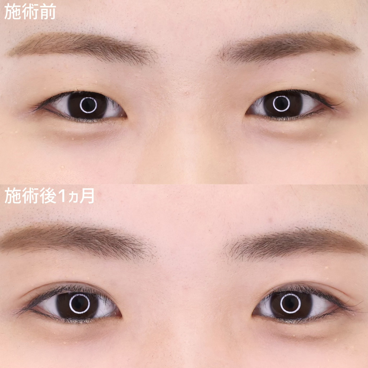 二重埋没法の症例写真 施術前後