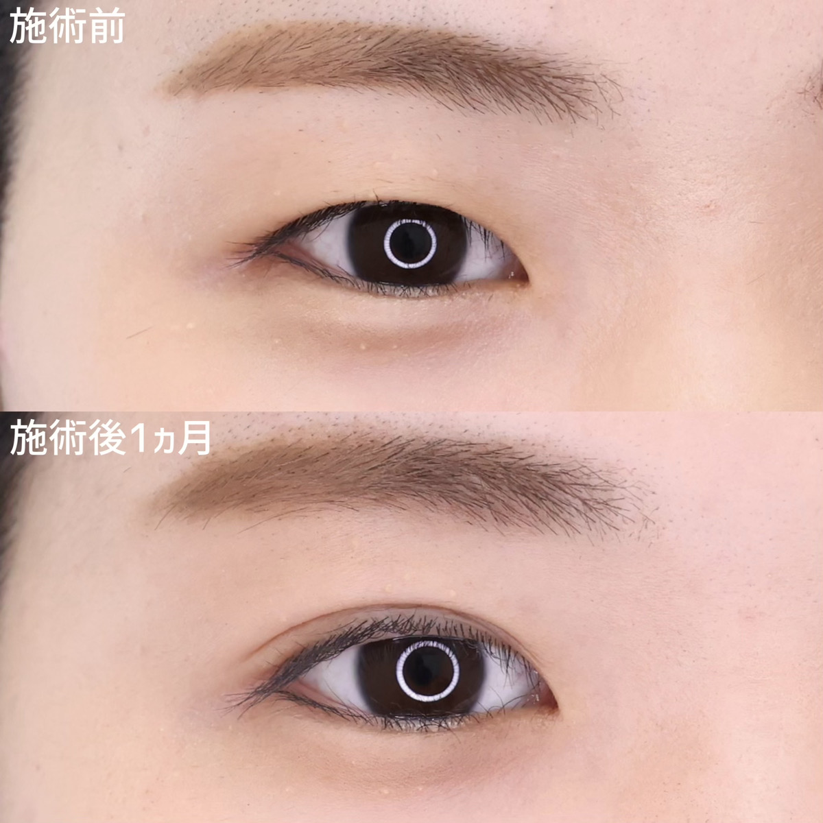 二重埋没法の症例写真 施術前後