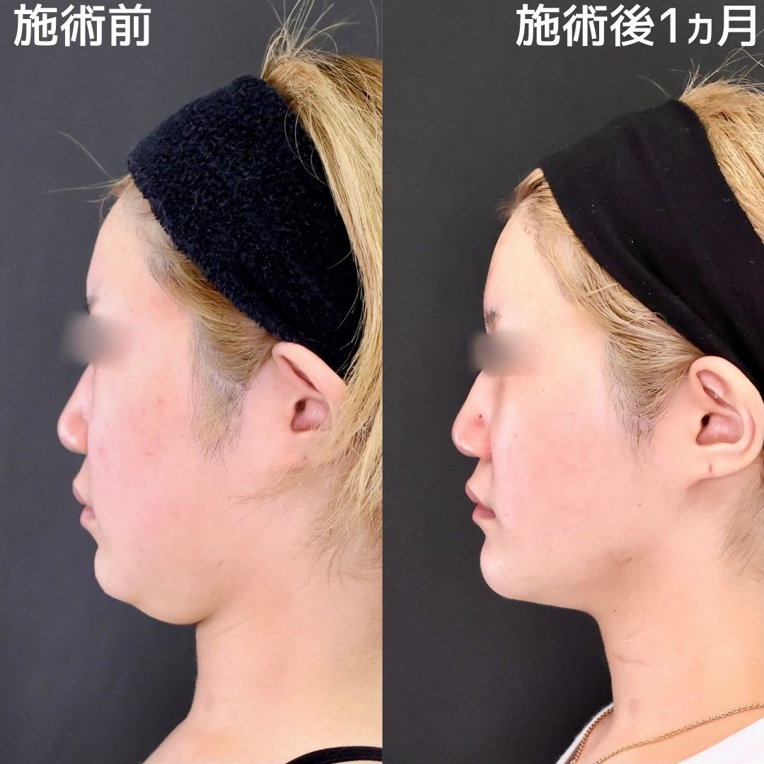 【糸リフト×脂肪除去・吸引】輪郭まわりすっきりで脱丸顔！