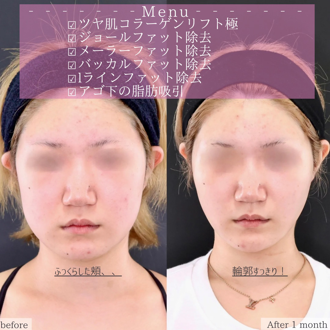 TAC式 ツヤ肌コラーゲンリフト®/メーラーファット除去/Lラインファット除去（エラ下脂肪除去）の症例写真 施術前後 