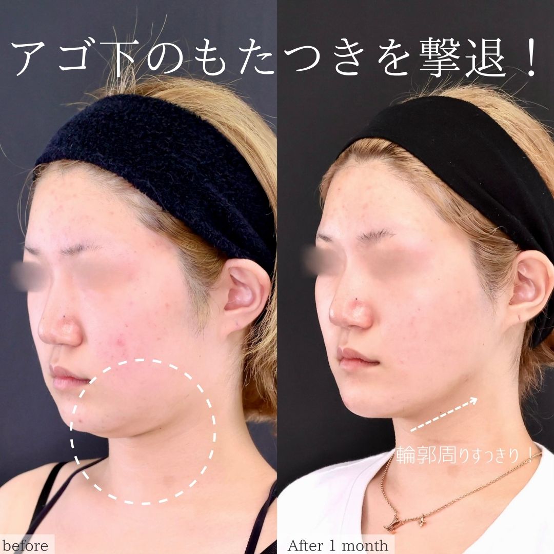 TAC式 ツヤ肌コラーゲンリフト®/メーラーファット除去/Lラインファット除去（エラ下脂肪除去）の症例写真 施術前後 