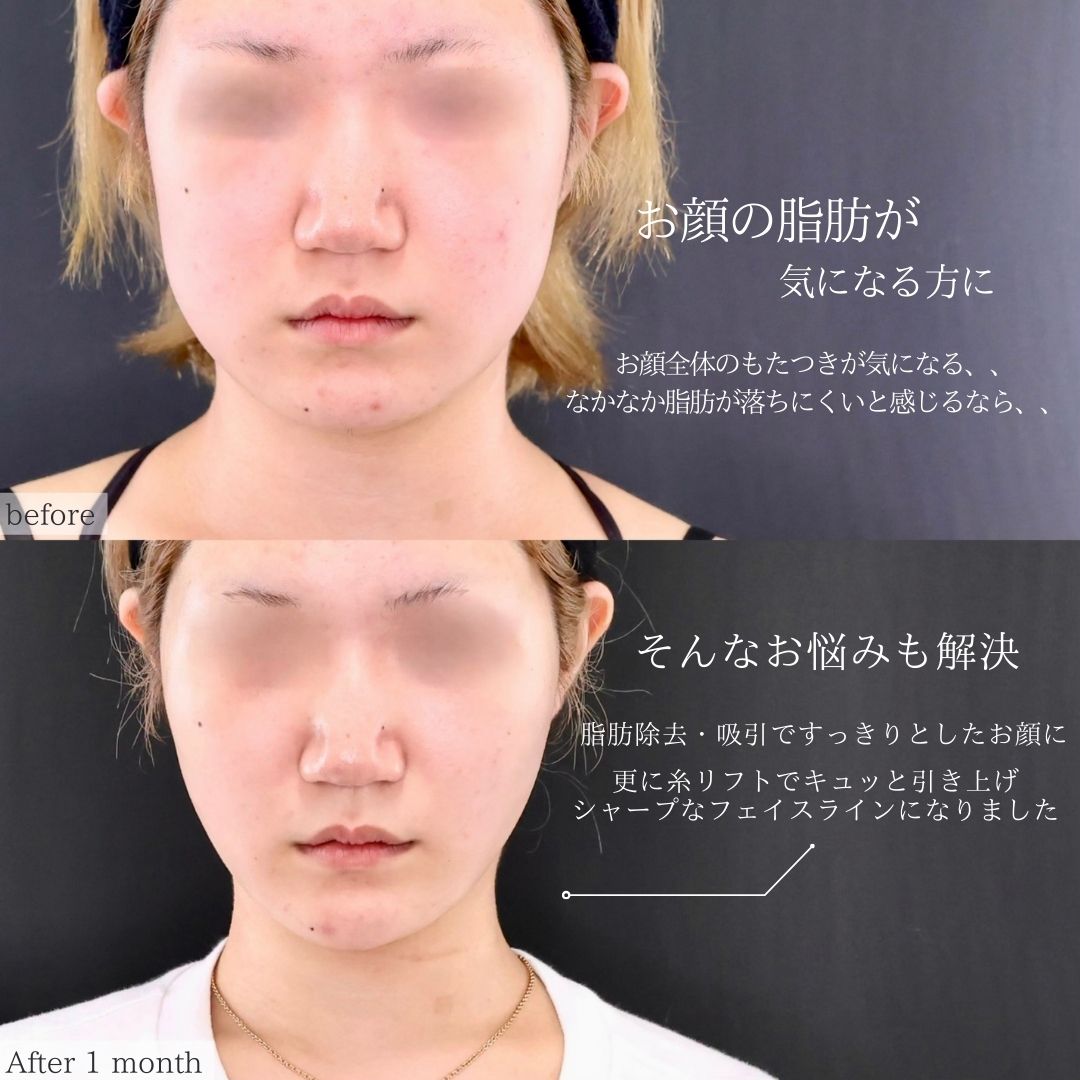 TAC式 ツヤ肌コラーゲンリフト®/メーラーファット除去/Lラインファット除去（エラ下脂肪除去）の症例写真 施術前後 