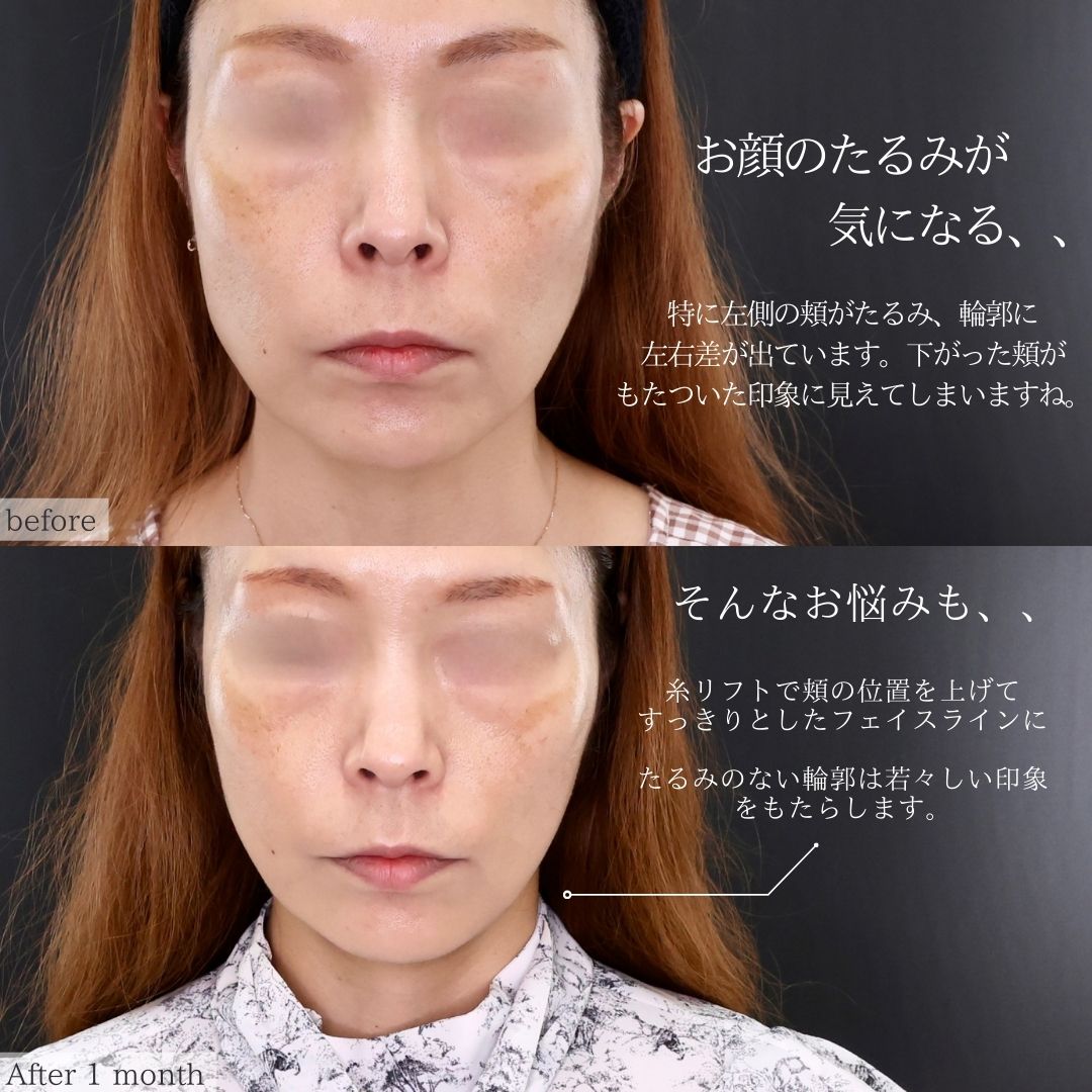 TAC式 ツヤ肌コラーゲンリフト®の症例写真 施術前後 