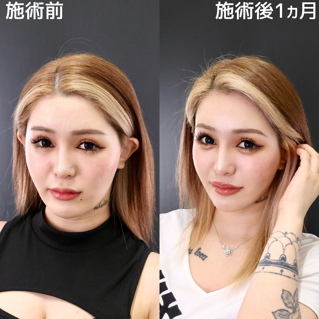 TAC式 ツヤ肌コラーゲンリフト®/下眼瞼脱脂術(目の下のたるみ取り・目の下の脂肪ふくらみ取り)の症例写真 施術前後