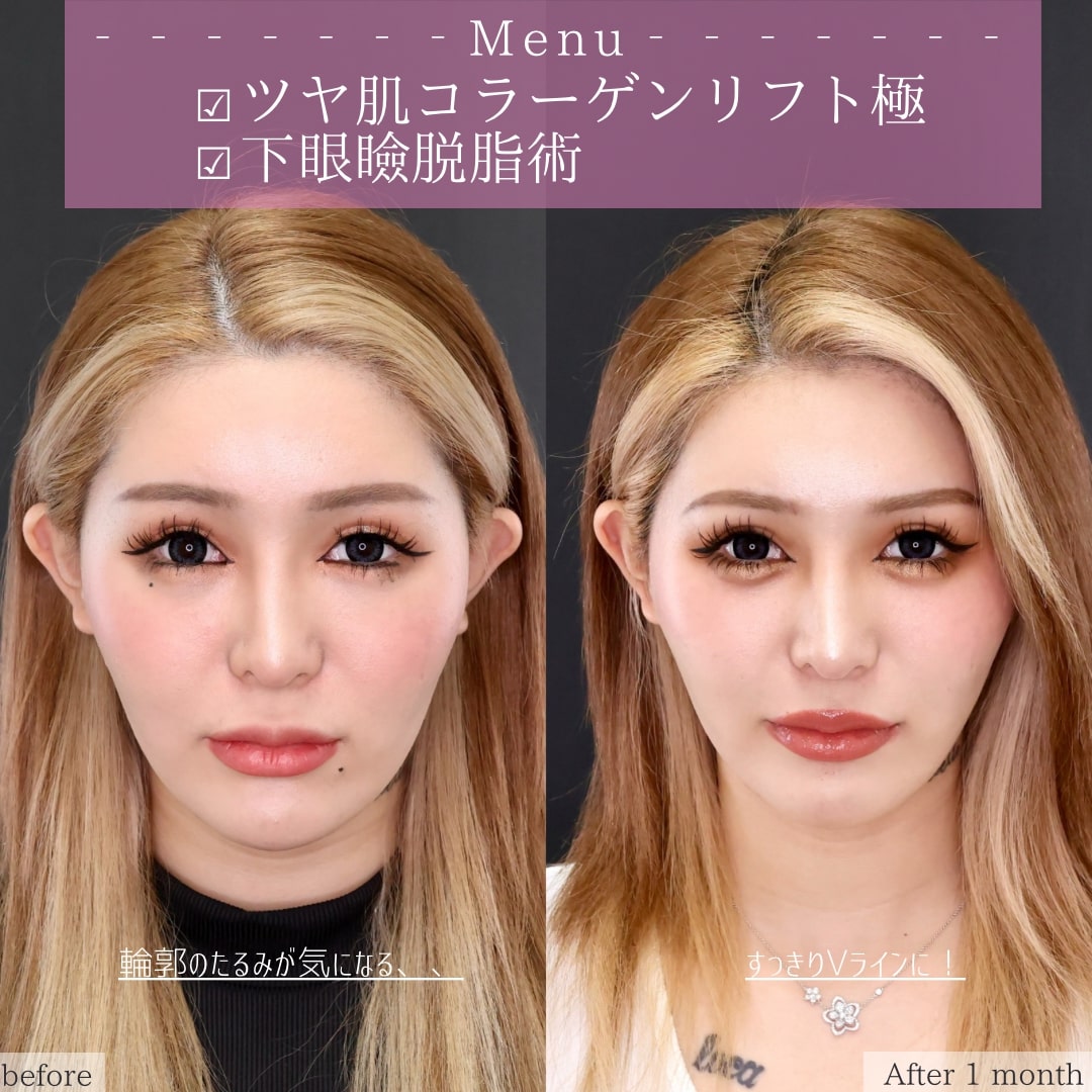 TAC式 ツヤ肌コラーゲンリフト®/下眼瞼脱脂術(目の下のたるみ取り・目の下の脂肪ふくらみ取り)の症例写真 施術前後