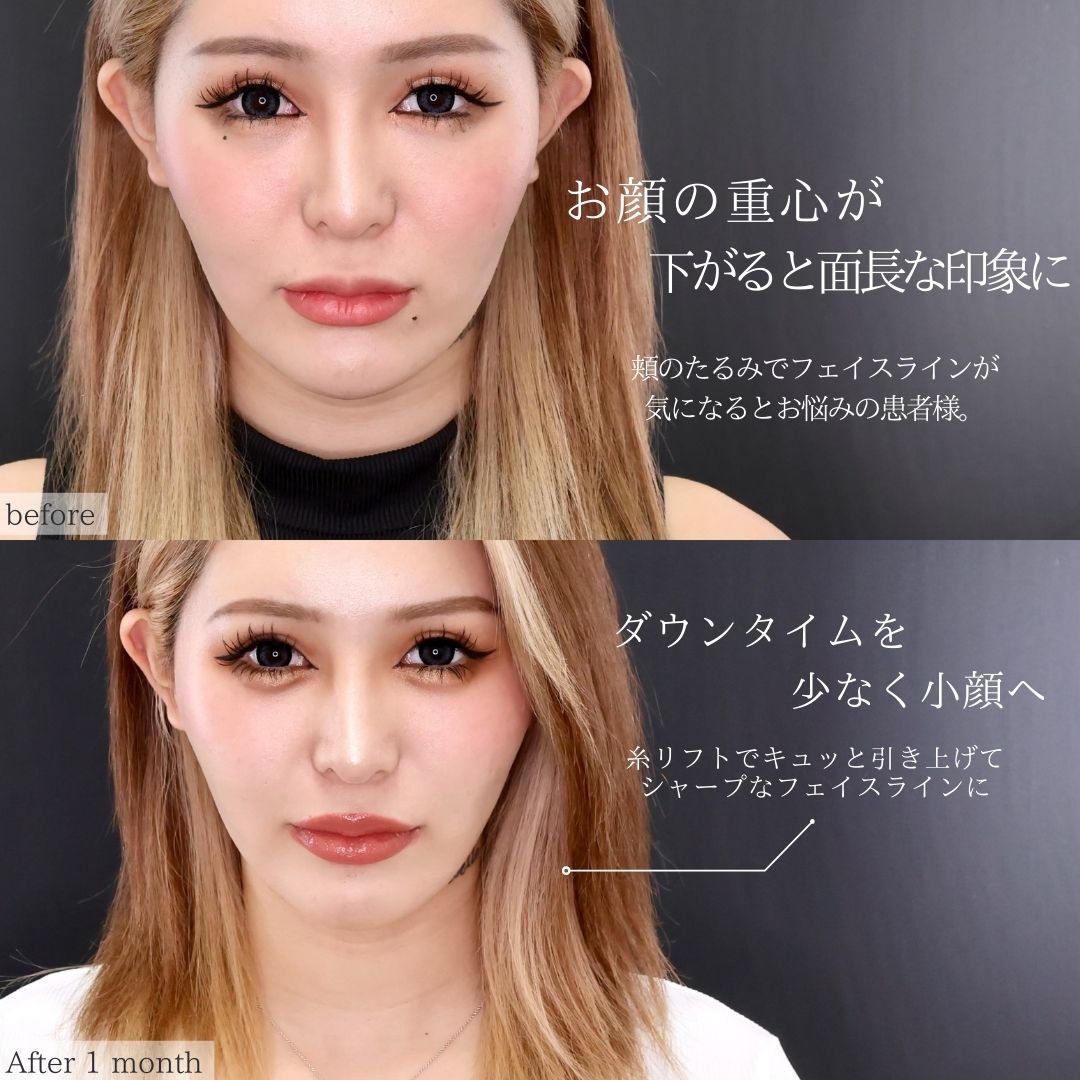 TAC式 ツヤ肌コラーゲンリフト®/下眼瞼脱脂術(目の下のたるみ取り・目の下の脂肪ふくらみ取り)の症例写真 施術前後