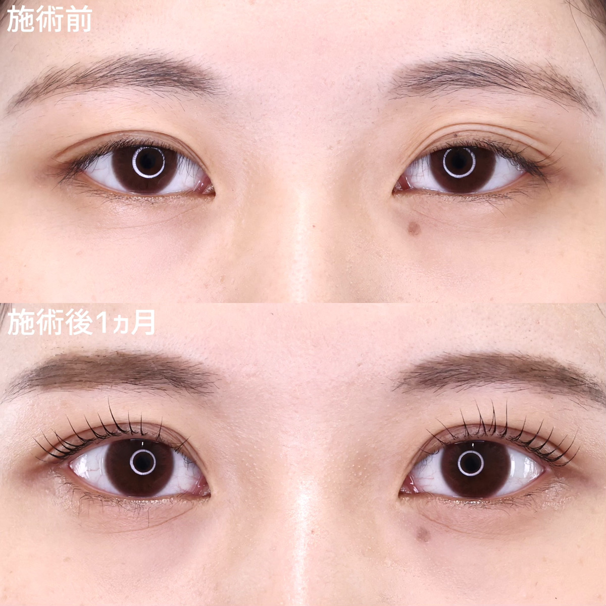 【二重埋没法】左右差・目の開きを改善してメイク映えのするお目元へ