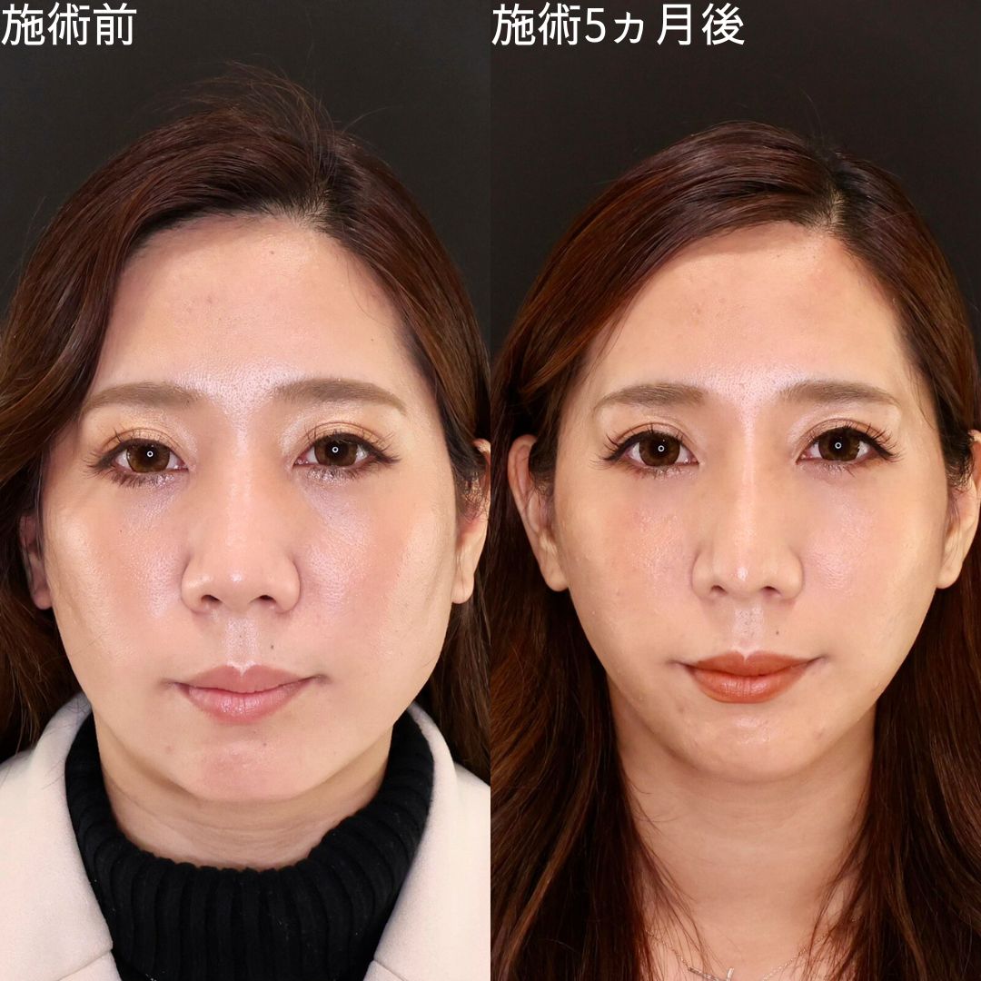 Dr.石橋の【小顔複合施術】で垢抜け小顔へ