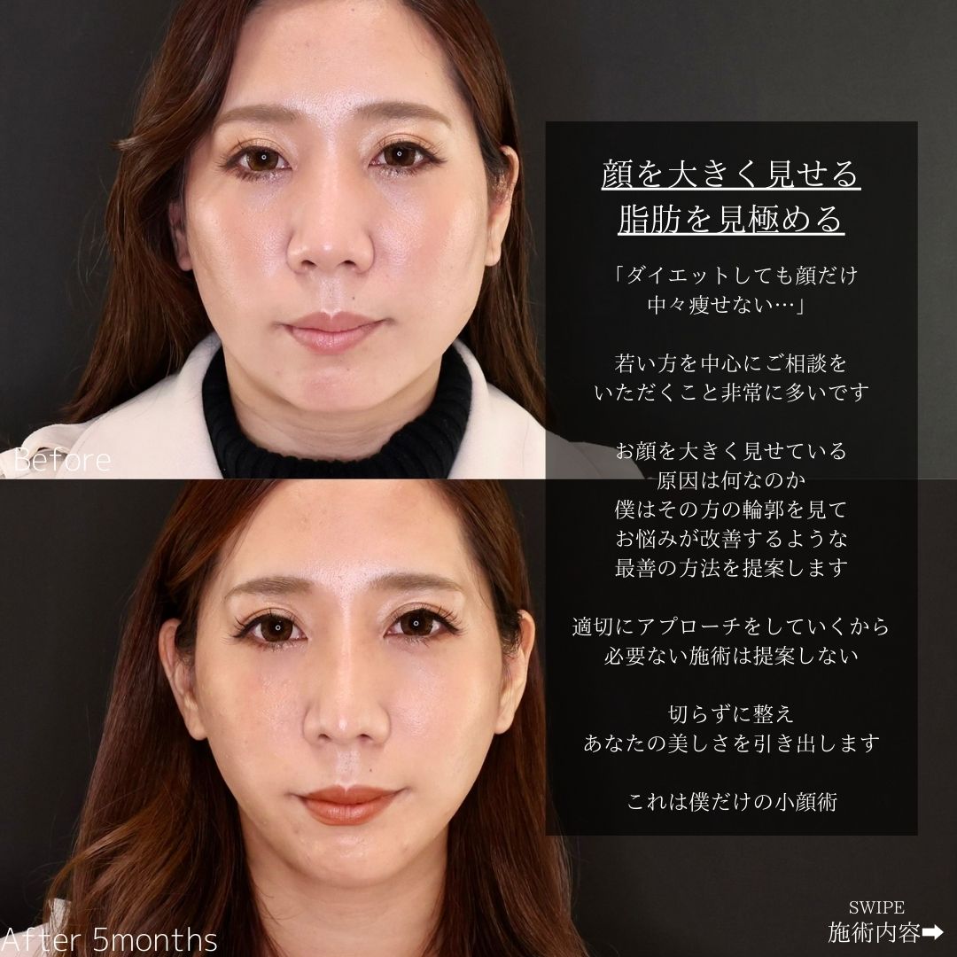 TAC式 ツヤ肌コラーゲンリフト®/顔の脂肪吸引/Lラインファット除去（エラ下脂肪除去）の症例写真 施術前後 