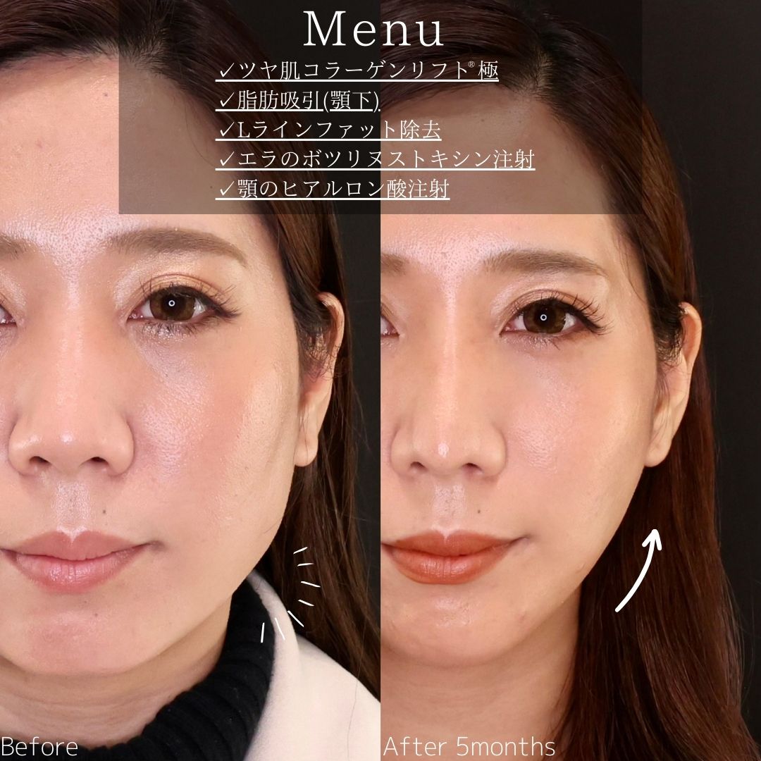 TAC式 ツヤ肌コラーゲンリフト®/顔の脂肪吸引/Lラインファット除去（エラ下脂肪除去）の症例写真 施術前後 