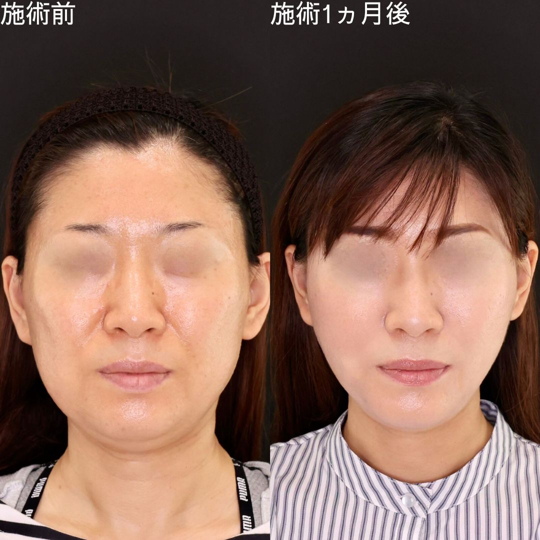 Dr.石橋執刀！驚きの別人級小顔術【糸リフト×脂肪除去】