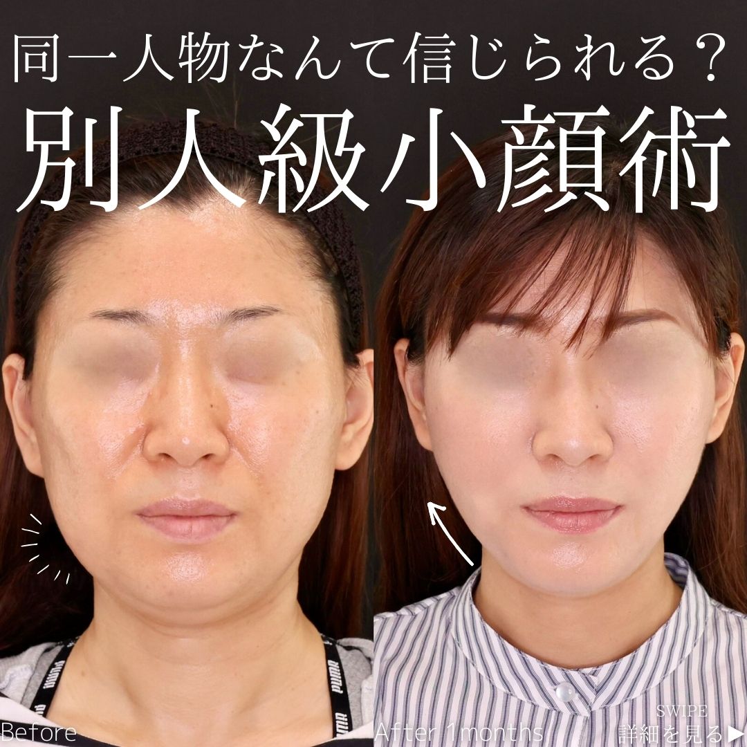 TAC式 ツヤ肌コラーゲンリフト®/ジョールファット除去/バッカルファット除去の症例写真 施術前後 