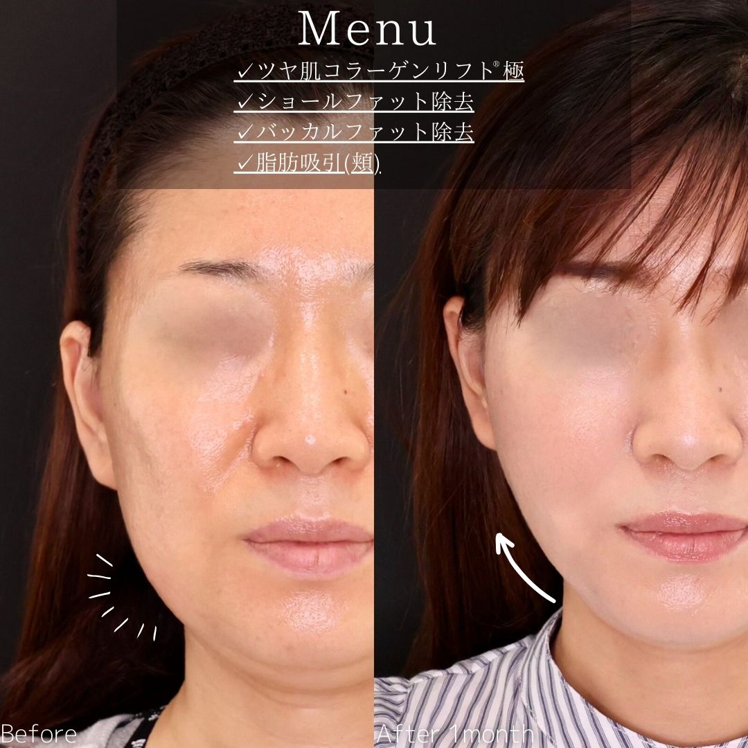 TAC式 ツヤ肌コラーゲンリフト®/ジョールファット除去/バッカルファット除去の症例写真 施術前後 