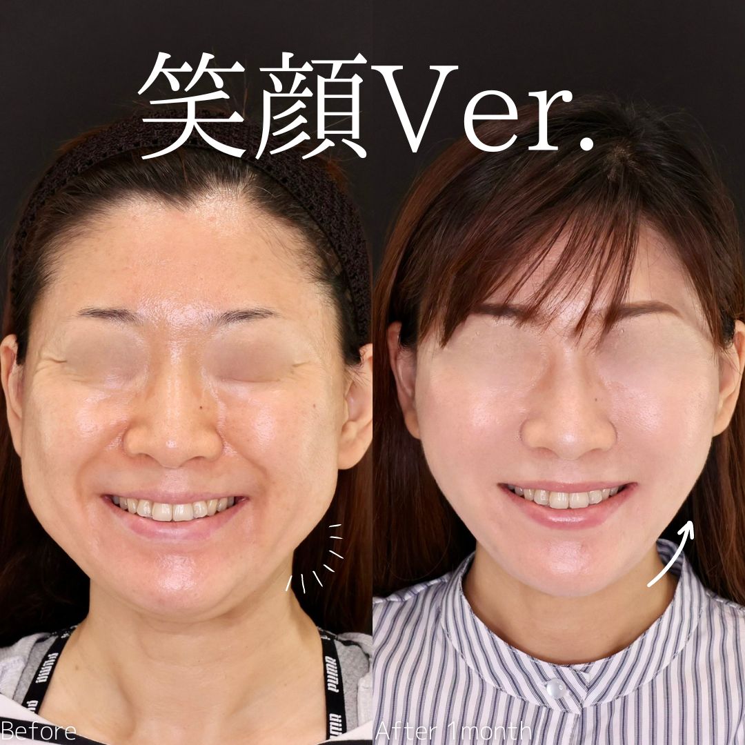 TAC式 ツヤ肌コラーゲンリフト®/ジョールファット除去/バッカルファット除去の症例写真 施術前後 