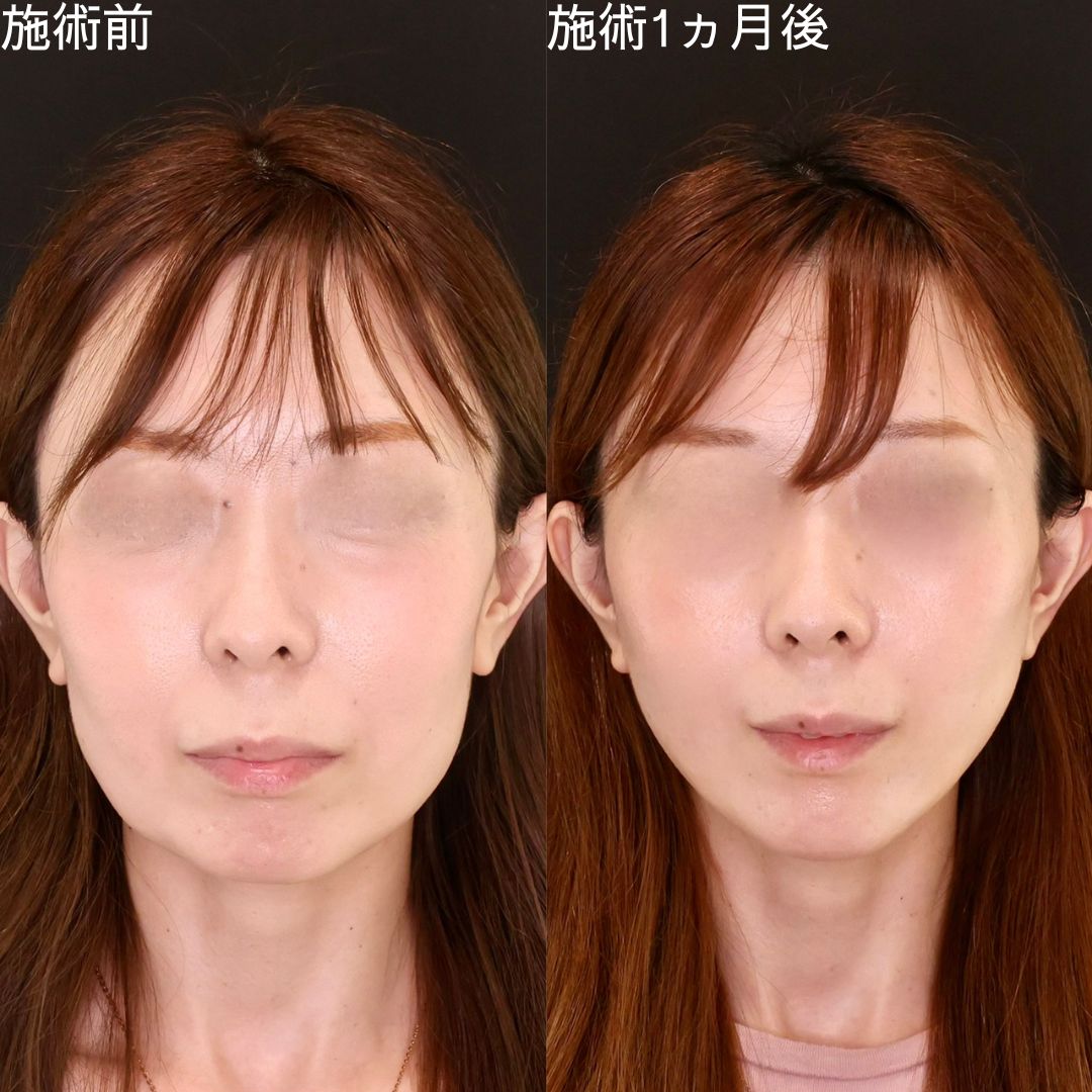 TAC式 ツヤ肌コラーゲンリフト®/顎のヒアルロン酸注射の症例写真 施術前後 