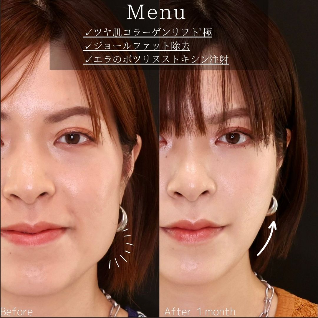 TAC式 ツヤ肌コラーゲンリフト®/ジョールファット除去/エラボトックス注射の症例写真 施術前後 