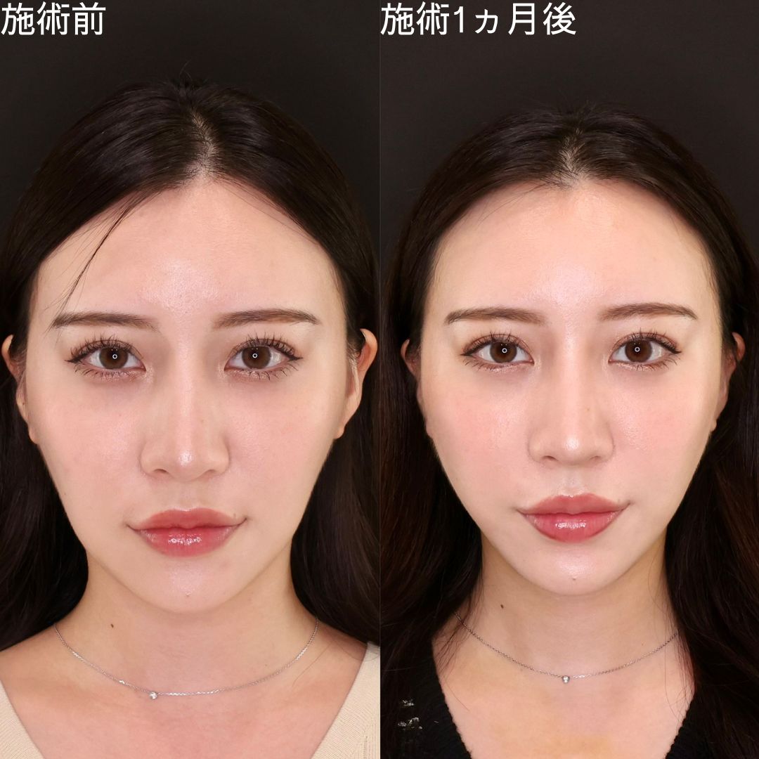 Dr.石橋の加工アプリ級小顔術【糸リフト】