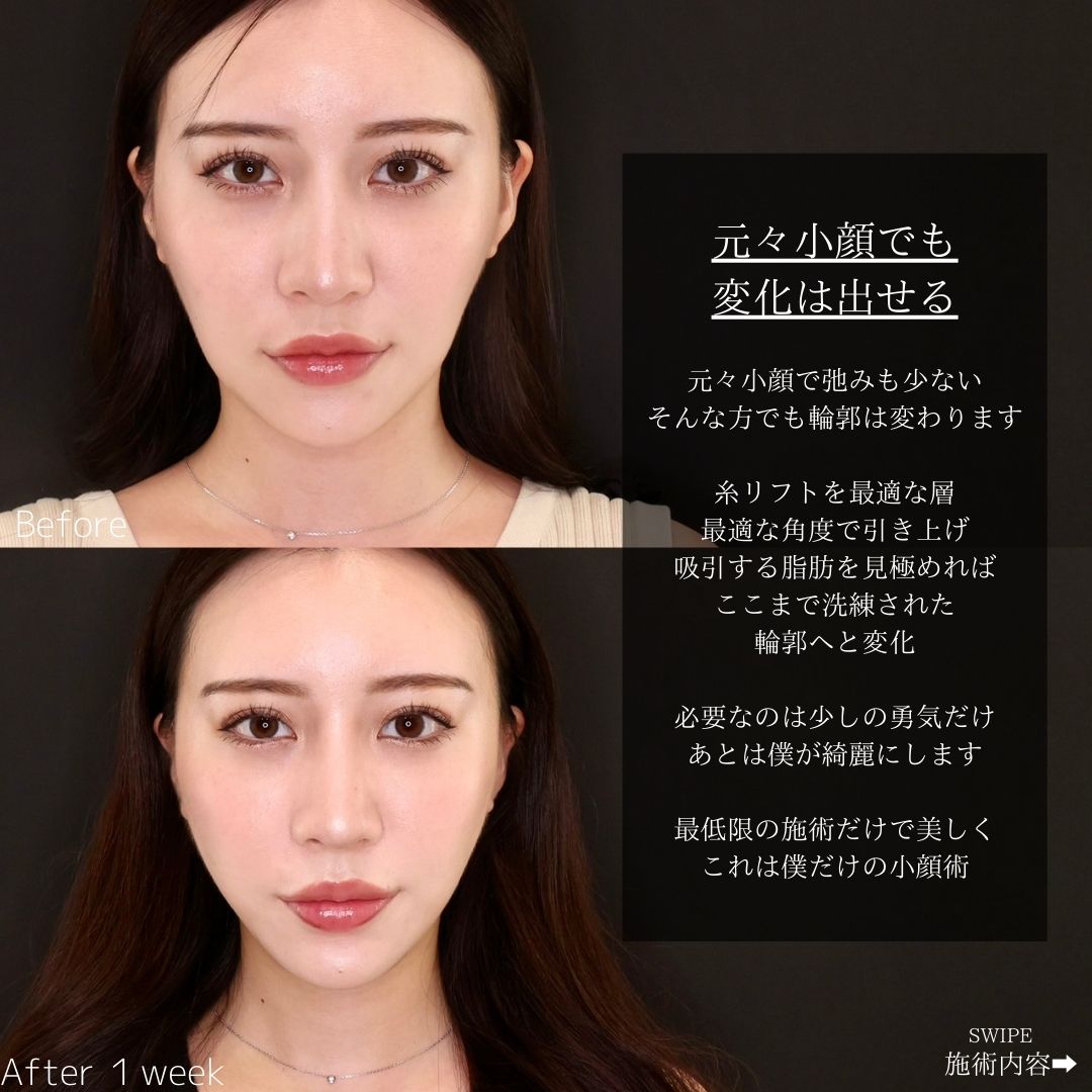 TAC式 ツヤ肌コラーゲンリフト®/顔の脂肪吸引の症例写真 施術前後 