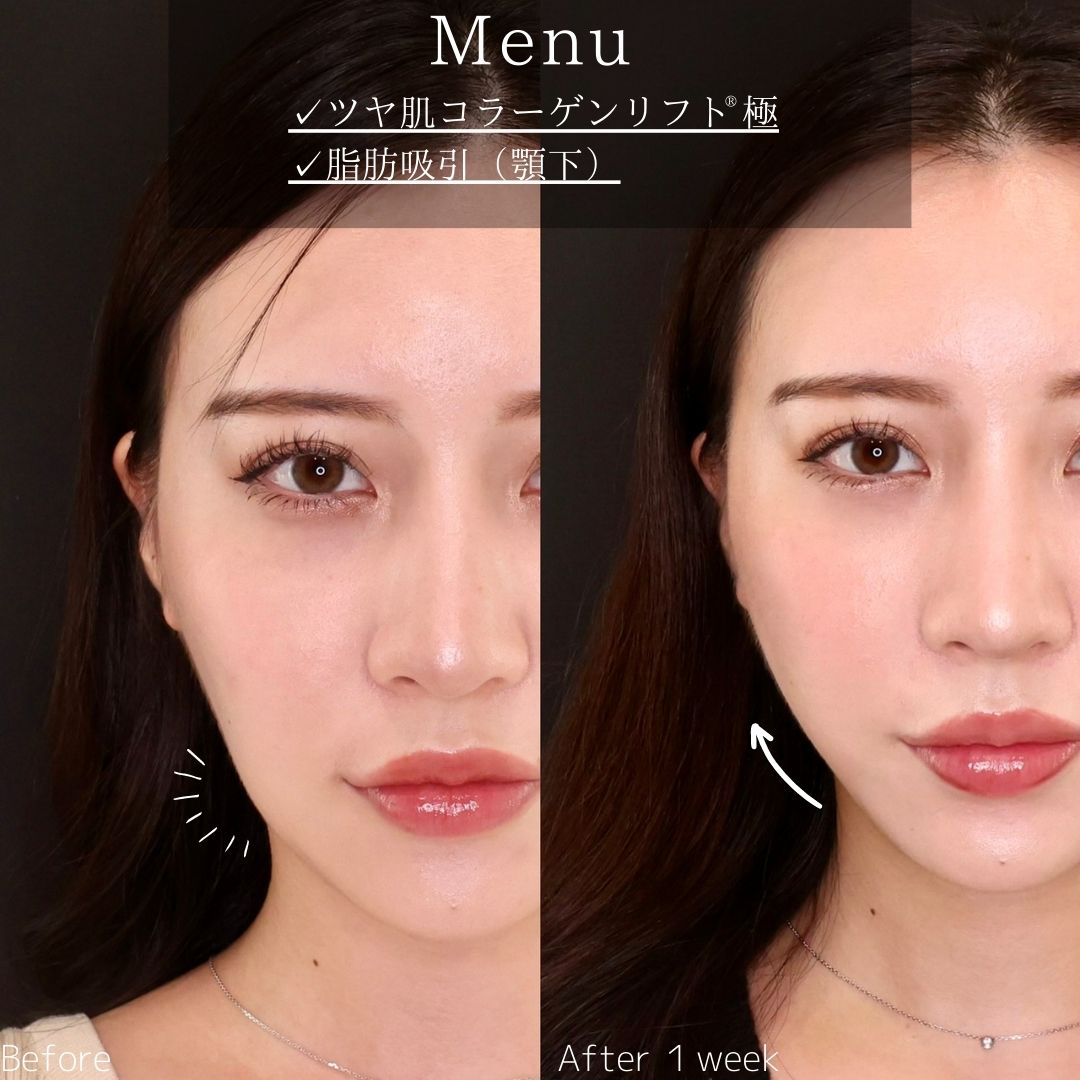 TAC式 ツヤ肌コラーゲンリフト®/顔の脂肪吸引の症例写真 施術前後 