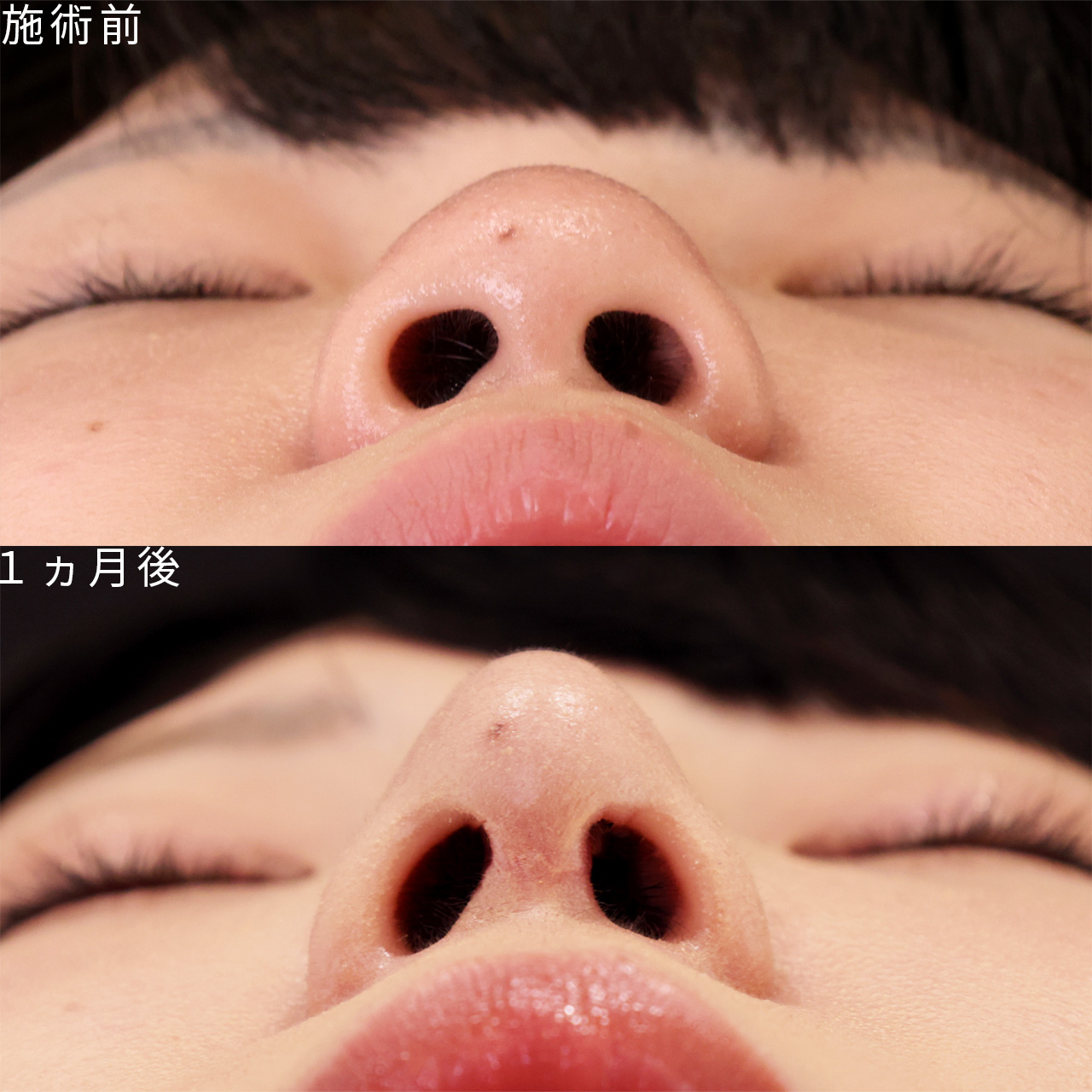 鼻尖形成・鼻尖縮小/隆鼻術(プロテーゼ・自家組織)/鼻先軟骨移植の症例写真 施術前後
