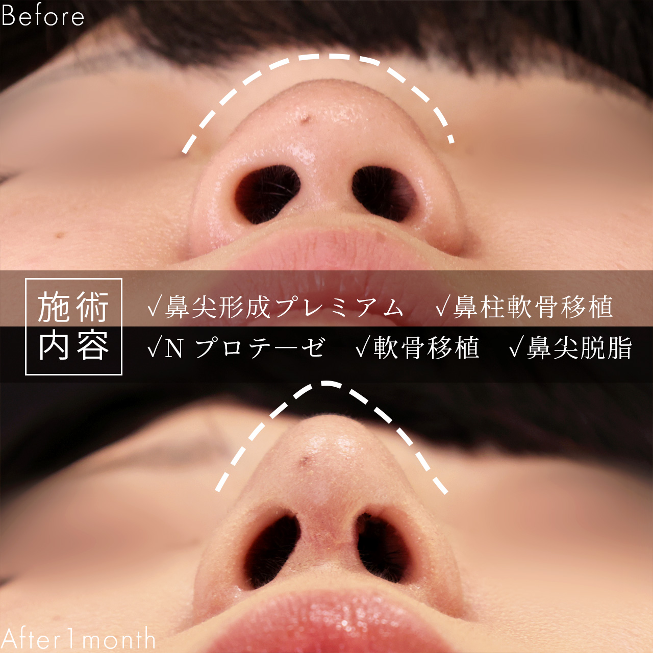 鼻尖形成・鼻尖縮小/隆鼻術(プロテーゼ・自家組織)/鼻先軟骨移植の症例写真 施術前後