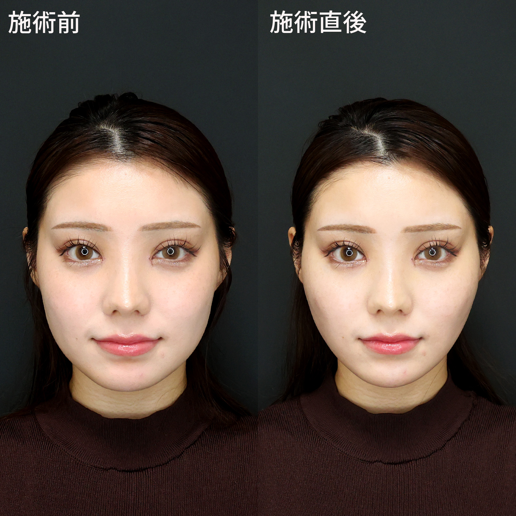 TAC式 ツヤ肌コラーゲンリフト®/顎のヒアルロン酸注射/エラボトックス注射の症例写真 施術前後