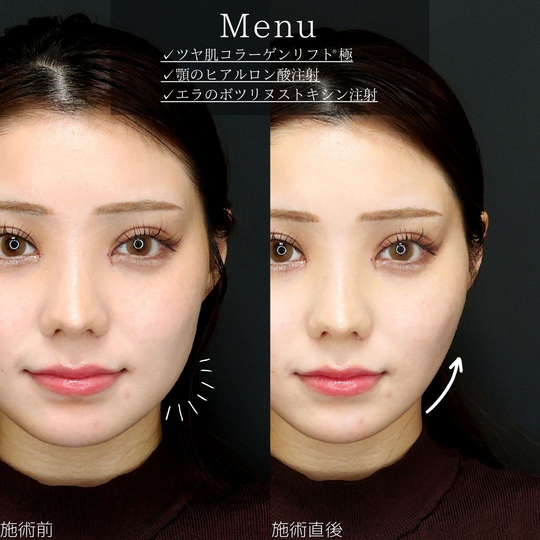 TAC式 ツヤ肌コラーゲンリフト®/顎のヒアルロン酸注射/エラボトックス注射の症例写真 施術前後
