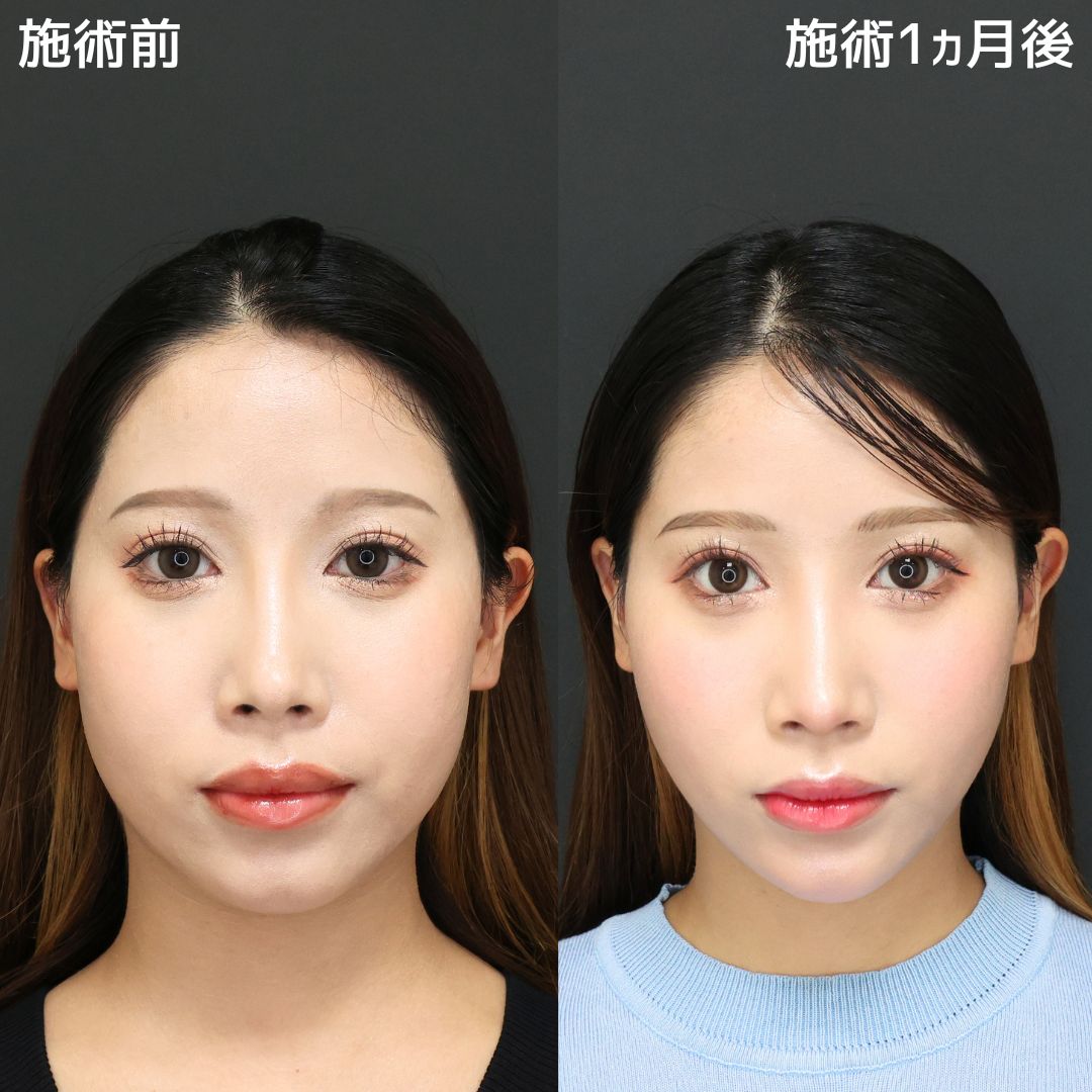 TAC式 ツヤ肌コラーゲンリフト®/顎のヒアルロン酸注射/エラボトックス注射の症例写真 施術前後