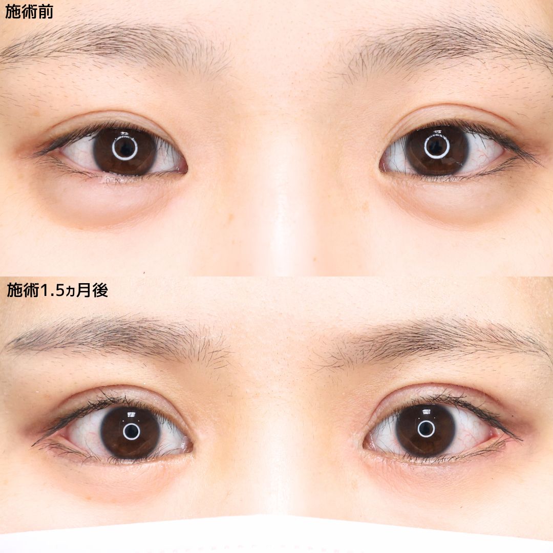 《目元フル整形》毎日のメイクが楽しくなる！