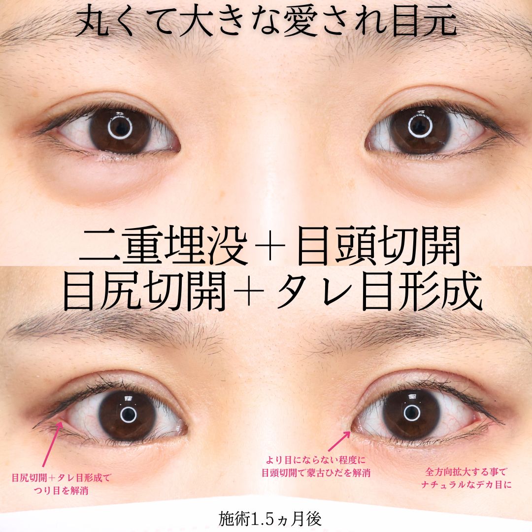 目頭切開術/目尻切開術/グラマラスライン（タレ目形成）の症例写真 施術前後 