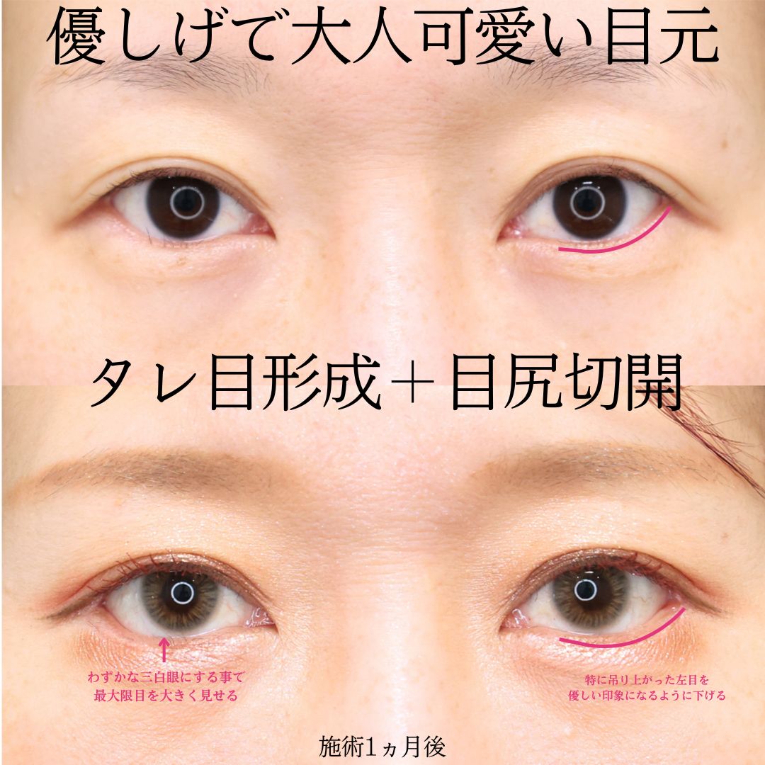 グラマラスライン（タレ目形成）/目尻切開術の症例写真 施術前後 