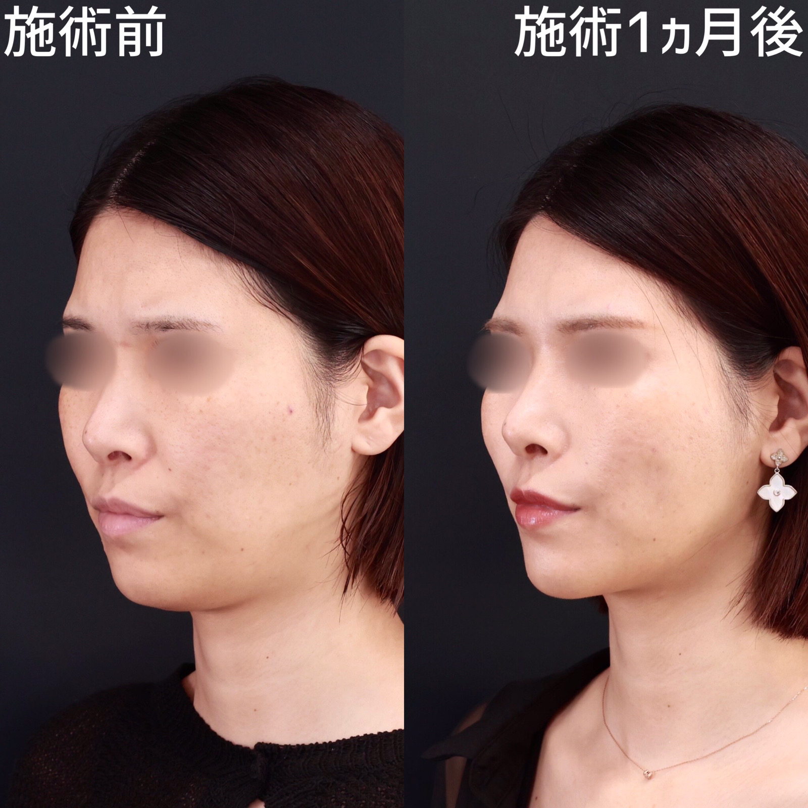 【糸リフト×脂肪除去】クッキリとしたフェイスラインを形成！