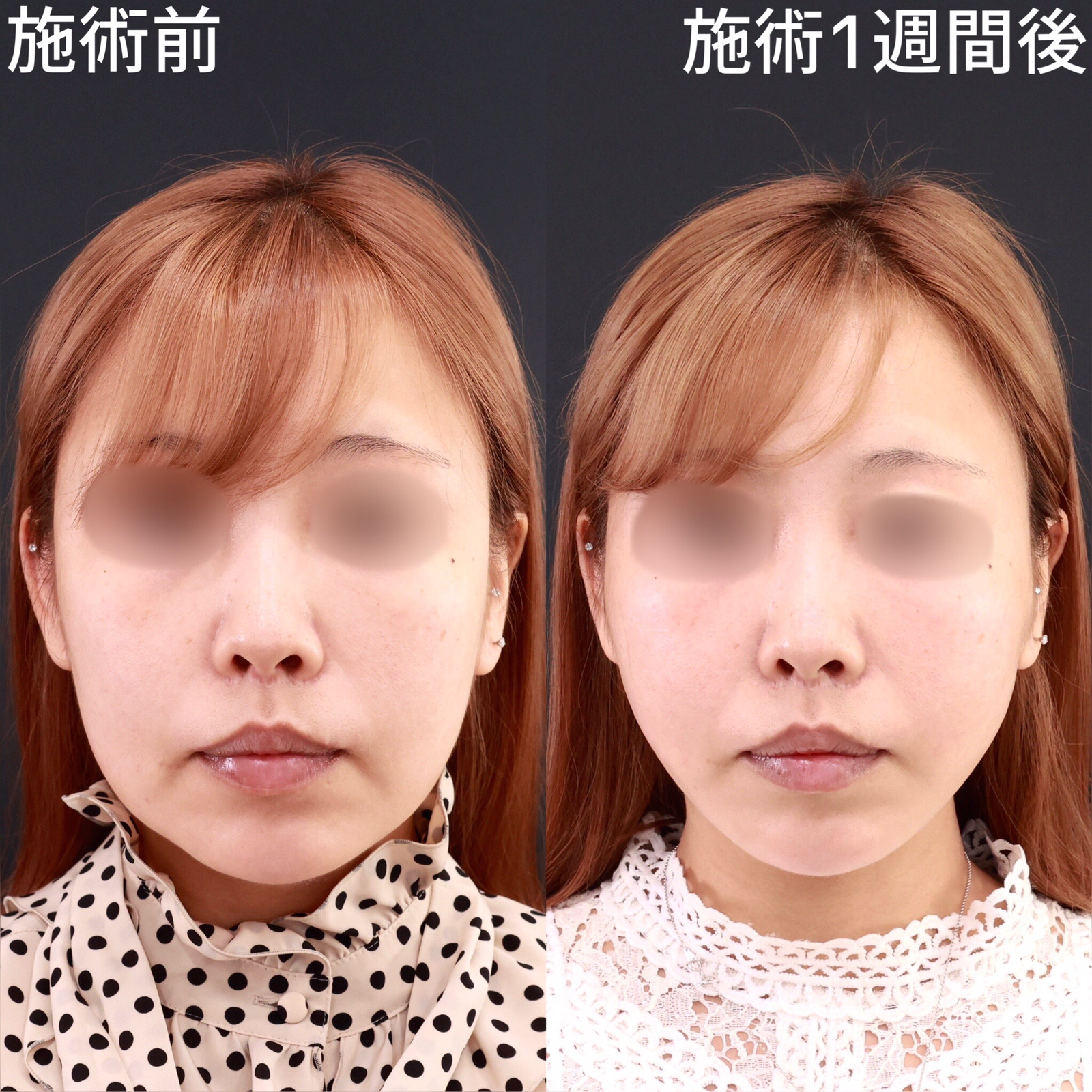 【糸リフト極】四角い輪郭を美しい卵型に整える！