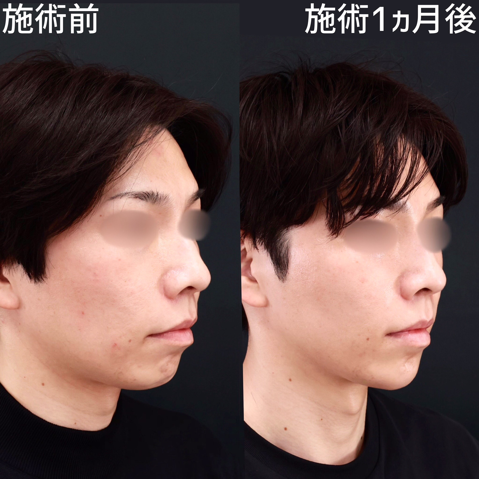 【糸リフト×ジョールファット除去】もたつきゼロのシャープな輪郭に！