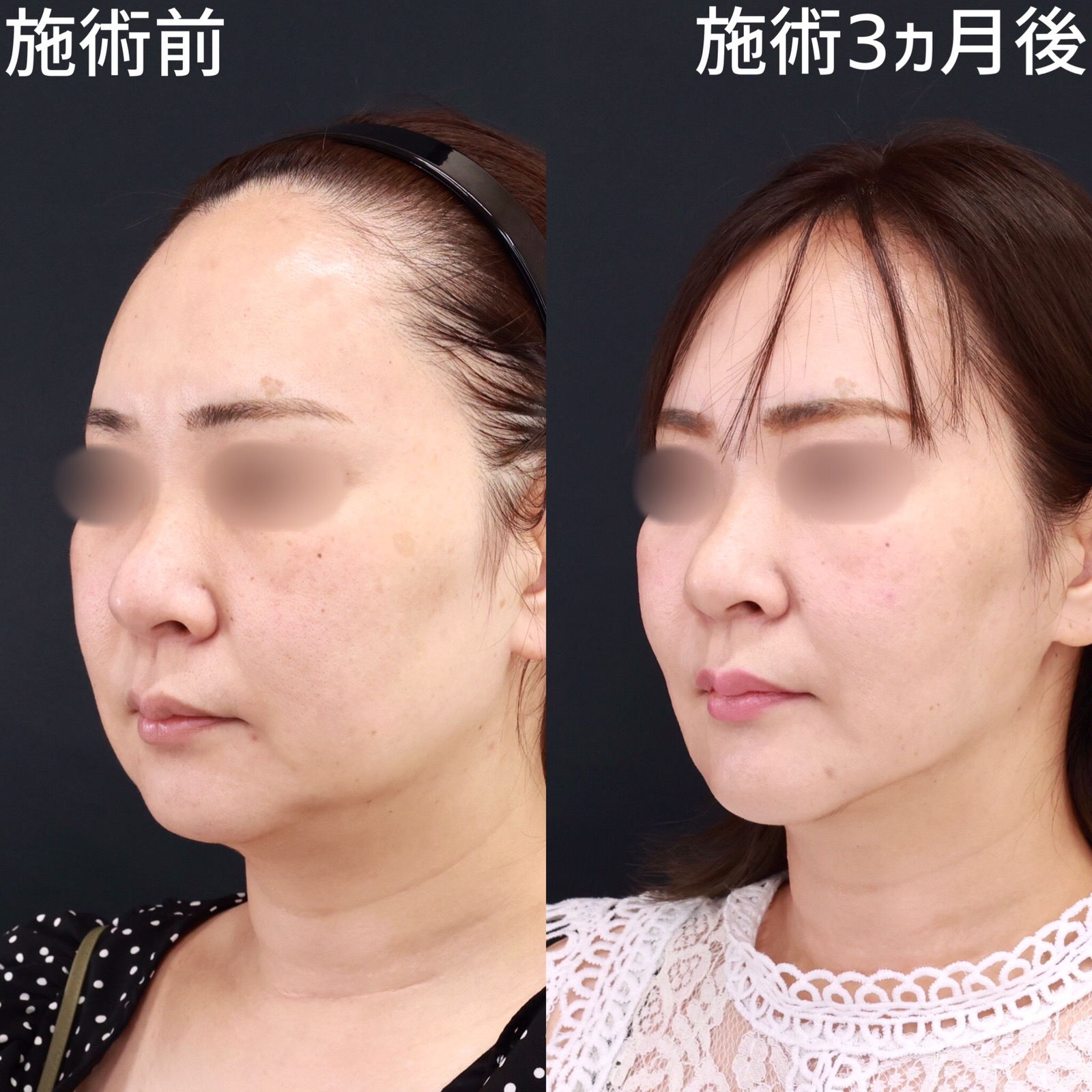 【糸リフト×脂肪除去】お顔のボリュームダウンで輪郭際立つ！
