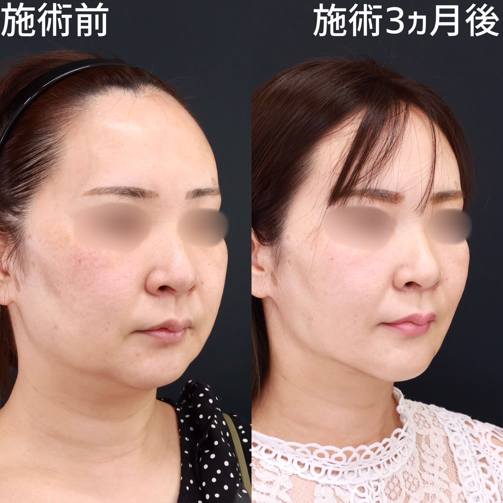 小顔整形｜パーフェクトフェイスライン/TAC式 ツヤ肌コラーゲンリフト®/顔の脂肪吸引の症例写真 施術前後 