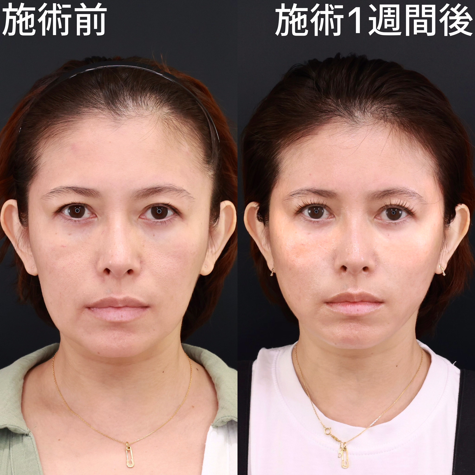 【糸リフト】極の糸リフトはここまで変わる！面長な輪郭を美しい卵型に