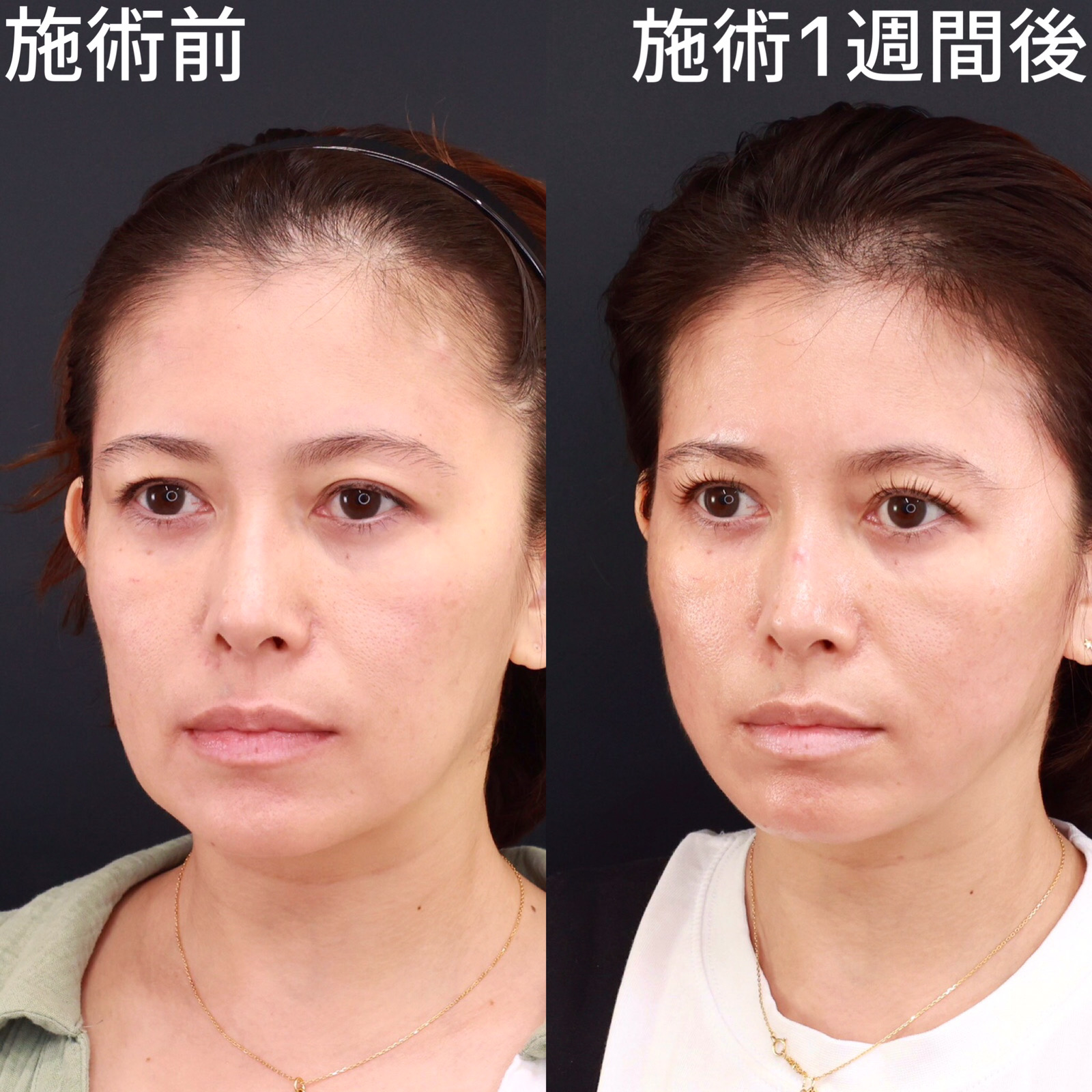 TAC式 ツヤ肌コラーゲンリフト®の症例写真 施術前後 