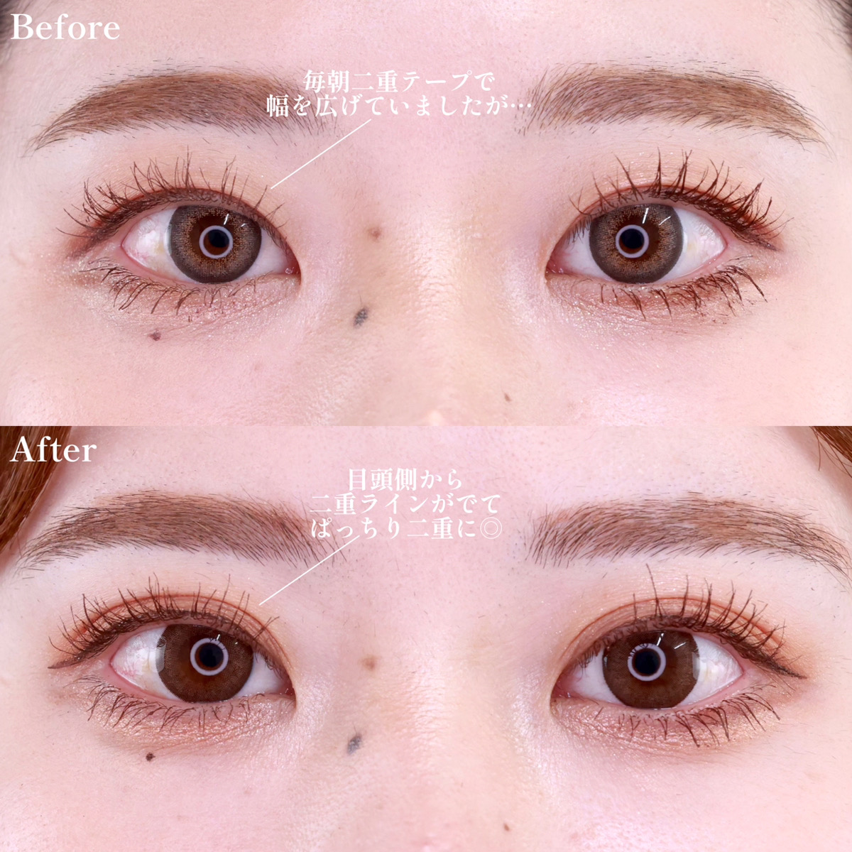 二重埋没法/目元:その他の症例写真 施術前後