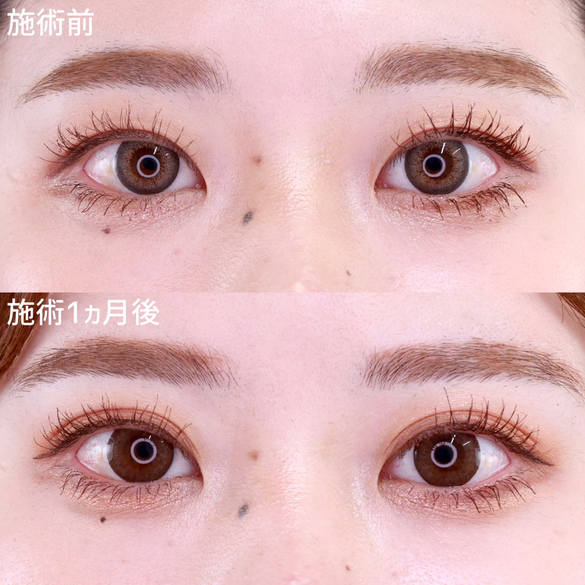 二重埋没法/目元:その他の症例写真 施術前後